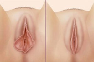 İç dudak estetiği labioplasti Kadınlar kulübü doktor takvimi doktorumsun en iyi lazerle rahim genital vajina dış iç dudak labium labioplasti labiaplasty labioplasty sarkması sarkıklığı küçültme küçültülmesi dolgusu dolgunlaştırma estetik estetiği ameliyatı lazerle şekiller çeşitleri kanama ağrı süre kanaması ağrısı süresi izi ucuz en uygun hesaplı fiyatlı fiyat fiyatı fiyatları ücret ücreti ücretleri yaptıranlar yorumlar yaptıranların yorumları kadınlar kulübü 2019 2020 2021 2022 2023 ekşi before after öncesi sonrası resim fotoğraf video izle randevu veren yapan hastane hastaneler bayan kadın doktor doktorlar klinik klinikler kliniği neden ne kadar nedir nasıl yapılır Türkiye İstanbul’da İstanbul Avrupa yakası Anadolu yakası Türkiye, Adana, Adıyaman, Afyonkarahisar, Ağrı, Aksaray, Amasya, Ankara, Antalya, Ardahan, Artvin, Aydın, Balıkesir, Bartın, Batman, Bayburt, Bilecik, Bingöl, Bitlis, Bolu, Burdur, Bursa, Çanakkale, Çankırı, Çorum, Denizli, Diyarbakır, Düzce, Edirne, Elazığ, Erzincan, Erzurum, Eskişehir, Gaziantep, Giresun, Gümüşhane, Hakkâri, Hatay, Iğdır, Isparta, İstanbul, İzmir, Kahramanmaraş, Karabük, Karaman, Kars, Kastamonu, Kayseri, Kilis, Kırıkkale, Kırklareli, Kırşehir, Kocaeli, Konya, Kütahya, Malatya, Manisa, Mardin, Mersin, Muğla, Muş, Nevşehir, Niğde, Ordu, Osmaniye, Rize, Sakarya, Samsun, Şanlıurfa, Siirt, Sinop, Sivas, Şırnak, Tekirdağ, Tokat, Trabzon, Tunceli, Uşak, Van, Yalova, Yozgat, Zonguldak, Karaman, Fethiye, Bodrum, Adalar, Arnavutköy, Ataşehir, Avcılar, Bağcılar, Bahçelievler, Bakırköy, Başakşehir, Bayrampaşa, Beşiktaş, Beykoz, Beylikdüzü, Beyoğlu, Büyükçekmece, Çatalca, Çekmeköy, Esenler, Esenyurt, Eyüp, Fatih, Gaziosmanpaşa, Güngören, Kadıköy, Kağıthane, Kartal, Küçükçekmece, Maltepe, Pendik, Sancaktepe, Sarıyer, Silivri, Sultanbeyli, Sultangazi, Şile, Şişli, Tuzla, Ümraniye, Üsküdar, Zeytinburnu, Şişli, Nişantaşı, Mecidiyeköy, Acıbadem, Gebze, Çorlu, Tarsus, Viranşehir Kadınlar kulübü doktor takvimi doktorumsun en iyi lazerle rahim genital vajina dış iç dudak labium labioplasti labiaplasty labioplasty sarkması sarkıklığı küçültme küçültülmesi dolgusu dolgunlaştırma estetik estetiği ameliyatı lazerle şekiller çeşitleri kanama ağrı süre kanaması ağrısı süresi izi ucuz en uygun hesaplı fiyatlı fiyat fiyatı fiyatları ücret ücreti ücretleri yaptıranlar yorumlar yaptıranların yorumları kadınlar kulübü 2019 2020 2021 2022 2023 ekşi before after öncesi sonrası resim fotoğraf video izle randevu veren yapan hastane hastaneler bayan kadın doktor doktorlar klinik klinikler kliniği neden ne kadar nedir nasıl yapılır Türkiye İstanbul’da, Adana, Adıyaman, Afyonkarahisar, Ağrı, Aksaray, Amasya, Ankara, Antalya, Ardahan, Artvin, Aydın, Balıkesir, Bartın, Batman, Bayburt, Bilecik, Bingöl, Bitlis, Bolu, Burdur, Bursa, Çanakkale, Çankırı, Çorum, Denizli, Diyarbakır, Düzce, Edirne, Elazığ, Erzincan, Erzurum, Eskişehir, Gaziantep, Giresun, Gümüşhane, Hakkâri, Hatay, Iğdır, Isparta, İstanbul, İzmir, Kahramanmaraş, Karabük, Karaman, Kars, Kastamonu, Kayseri, Kilis, Kırıkkale, Kırklareli, Kırşehir, Kocaeli, Konya, Kütahya, Malatya, Manisa, Mardin, Mersin, Muğla, Muş, Nevşehir, Niğde, Ordu, Osmaniye, Rize, Sakarya, Samsun, Şanlıurfa, Siirt, Sinop, Sivas, Şırnak, Tekirdağ, Tokat, Trabzon, Tunceli, Uşak, Van, Yalova, Yozgat, Zonguldak, Karaman, Fethiye, Bodrum, Adalar, Arnavutköy, Ataşehir, Avcılar, Bağcılar, Bahçelievler, Bakırköy, Başakşehir, Bayrampaşa, Beşiktaş, Beykoz, Beylikdüzü, Beyoğlu, Büyükçekmece, Çatalca, Çekmeköy, Esenler, Esenyurt, Eyüp, Fatih, Gaziosmanpaşa, Güngören, Kadıköy, Kağıthane, Kartal, Küçükçekmece, Maltepe, Pendik, Sancaktepe, Sarıyer, Silivri, Sultanbeyli, Sultangazi, Şile, Şişli, Tuzla, Ümraniye, Üsküdar, Zeytinburnu, Şişli, Nişantaşı, Mecidiyeköy, Acıbadem, Gebze, Çorlu, Tarsus, Viranşehir, İstanbul Avrupa yakası Anadolu yakası Kadınlar kulübü doktor takvimi doktorumsun en iyi lazerle rahim genital vajina dış iç dudak labium labioplasti labiaplasty labioplasty sarkması sarkıklığı küçültme küçültülmesi dolgusu dolgunlaştırma estetik estetiği ameliyatı lazerle şekiller çeşitleri kanama ağrı süre kanaması ağrısı süresi izi ucuz en uygun hesaplı fiyatlı fiyat fiyatı fiyatları ücret ücreti ücretleri yaptıranlar yorumlar yaptıranların yorumları kadınlar kulübü 2019 2020 2021 2022 2023 ekşi before after öncesi sonrası resim fotoğraf video izle randevu veren yapan hastane hastaneler bayan kadın doktor doktorlar klinik klinikler kliniği neden ne kadar nedir nasıl yapılır.