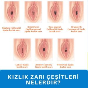 Kızlık zarı dikimi Kadınlar kulübü doktor takvimi doktorumsun en iyi kızlık zarı dikimi himenoplasti bekaret bakirelik testi kalıcı geçici lazerle muayenesi zedelenmesi kanaması onarımı tamiri dikişi kızlık zarı dikimi fiyatları fiyatı ücreti ücretleri Kızlık zarı dikimi himenoplasti bekaret kalıcı geçici lazerle muayenesi zedelenmesi kanaması onarımı tamiri dikişi kızlık zarı dikimi fiyat fiyatı fiyatları ücret ücreti ücretleri yaptıranlar yorumlar yaptıranların yorumları kadınlar kulübü 2019 2020 2021 2022 2023 ekşi before after öncesi sonrası resim fotoğraf video izle randevu veren yapan hastane hastaneler bayan kadın doktor doktorlar klinik klinikler kliniği nedir nasıl yapılır İstanbul’da İstanbul Avrupa yakası Anadolu yakası Türkiye, Adana, Adıyaman, Afyonkarahisar, Ağrı, Aksaray, Amasya, Ankara, Antalya, Ardahan, Artvin, Aydın, Balıkesir, Bartın, Batman, Bayburt, Bilecik, Bingöl, Bitlis, Bolu, Burdur, Bursa, Çanakkale, Çankırı, Çorum, Denizli, Diyarbakır, Düzce, Edirne, Elazığ, Erzincan, Erzurum, Eskişehir, Gaziantep, Giresun, Gümüşhane, Hakkâri, Hatay, Iğdır, Isparta, İstanbul, İzmir, Kahramanmaraş, Karabük, Karaman, Kars, Kastamonu, Kayseri, Kilis, Kırıkkale, Kırklareli, Kırşehir, Kocaeli, Konya, Kütahya, Malatya, Manisa, Mardin, Mersin, Muğla, Muş, Nevşehir, Niğde, Ordu, Osmaniye, Rize, Sakarya, Samsun, Şanlıurfa, Siirt, Sinop, Sivas, Şırnak, Tekirdağ, Tokat, Trabzon, Tunceli, Uşak, Van, Yalova, Yozgat, Zonguldak, Karaman, Fethiye, Bodrum, Adalar, Arnavutköy, Ataşehir, Avcılar, Bağcılar, Bahçelievler, Bakırköy, Başakşehir, Bayrampaşa, Beşiktaş, Beykoz, Beylikdüzü, Beyoğlu, Büyükçekmece, Çatalca, Çekmeköy, Esenler, Esenyurt, Eyüp, Fatih, Gaziosmanpaşa, Güngören, Kadıköy, Kağıthane, Kartal, Küçükçekmece, Maltepe, Pendik, Sancaktepe, Sarıyer, Silivri, Sultanbeyli, Sultangazi, Şile, Şişli, Tuzla, Ümraniye, Üsküdar, Zeytinburnu, Şişli, Nişantaşı, Mecidiyeköy, Acıbadem, Gebze, Çorlu, Tarsus, Viranşehir Kadınlar kulübü doktor takvimi doktorumsun en iyi kızlık zarı dikimi himenoplasti bekaret bakirelik testi kalıcı geçici lazerle muayenesi zedelenmesi kanaması onarımı tamiri dikişi kızlık zarı dikimi fiyatları fiyatı ücreti ücretleri Kızlık zarı dikimi himenoplasti bekaret kalıcı geçici lazerle muayenesi zedelenmesi kanaması onarımı tamiri dikişi kızlık zarı dikimi fiyat fiyatı fiyatları ücret ücreti ücretleri yaptıranlar yorumlar yaptıranların yorumları kadınlar kulübü 2019 2020 2021 2022 2023 ekşi before after öncesi sonrası resim fotoğraf video izle randevu veren yapan hastane hastaneler bayan kadın doktor doktorlar klinik klinikler kliniği nedir nasıl yapılır Türkiye, Adana, Adıyaman, Afyonkarahisar, Ağrı, Aksaray, Amasya, Ankara, Antalya, Ardahan, Artvin, Aydın, Balıkesir, Bartın, Batman, Bayburt, Bilecik, Bingöl, Bitlis, Bolu, Burdur, Bursa, Çanakkale, Çankırı, Çorum, Denizli, Diyarbakır, Düzce, Edirne, Elazığ, Erzincan, Erzurum, Eskişehir, Gaziantep, Giresun, Gümüşhane, Hakkâri, Hatay, Iğdır, Isparta, İstanbul, İzmir, Kahramanmaraş, Karabük, Karaman, Kars, Kastamonu, Kayseri, Kilis, Kırıkkale, Kırklareli, Kırşehir, Kocaeli, Konya, Kütahya, Malatya, Manisa, Mardin, Mersin, Muğla, Muş, Nevşehir, Niğde, Ordu, Osmaniye, Rize, Sakarya, Samsun, Şanlıurfa, Siirt, Sinop, Sivas, Şırnak, Tekirdağ, Tokat, Trabzon, Tunceli, Uşak, Van, Yalova, Yozgat, Zonguldak, Karaman, Fethiye, Bodrum, Adalar, Arnavutköy, Ataşehir, Avcılar, Bağcılar, Bahçelievler, Bakırköy, Başakşehir, Bayrampaşa, Beşiktaş, Beykoz, Beylikdüzü, Beyoğlu, Büyükçekmece, Çatalca, Çekmeköy, Esenler, Esenyurt, Eyüp, Fatih, Gaziosmanpaşa, Güngören, Kadıköy, Kağıthane, Kartal, Küçükçekmece, Maltepe, Pendik, Sancaktepe, Sarıyer, Silivri, Sultanbeyli, Sultangazi, Şile, Şişli, Tuzla, Ümraniye, Üsküdar, Zeytinburnu, Şişli, Nişantaşı, Mecidiyeköy, Acıbadem, Gebze, Çorlu, Tarsus, Viranşehir, İstanbul Avrupa yakası Anadolu yakası Kadınlar kulübü doktor takvimi doktorumsun en iyi Kızlık zarı dikimi himenoplasti bekaret bakirelik testi kalıcı geçici lazerle muayenesi zedelenmesi kanaması onarımı tamiri dikişi kızlık zarı dikimi fiyatları fiyatı ücreti ücretleri Kızlık zarı dikimi himenoplasti bekaret kalıcı geçici lazerle muayenesi zedelenmesi kanaması onarımı tamiri dikişi kızlık zarı dikimi fiyat fiyatı fiyatları ücret ücreti ücretleri yaptıranlar yorumlar yaptıranların yorumları kadınlar kulübü 2019 2020 2021 2022 2023 ekşi before after öncesi sonrası resim fotoğraf video izle randevu veren yapan hastane hastaneler bayan kadın doktor doktorlar klinik klinikler kliniği nedir nasıl yapılır.