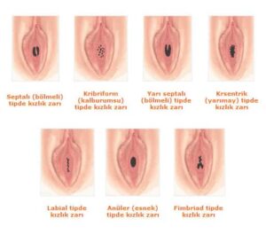 Kızlık zarı dikimi Kadınlar kulübü doktor takvimi doktorumsun en iyi kızlık zarı dikimi himenoplasti bekaret bakirelik testi kalıcı geçici lazerle muayenesi zedelenmesi kanaması onarımı tamiri dikişi kızlık zarı dikimi fiyatları fiyatı ücreti ücretleri Kızlık zarı dikimi himenoplasti bekaret kalıcı geçici lazerle muayenesi zedelenmesi kanaması onarımı tamiri dikişi kızlık zarı dikimi fiyat fiyatı fiyatları ücret ücreti ücretleri yaptıranlar yorumlar yaptıranların yorumları kadınlar kulübü 2019 2020 2021 2022 2023 ekşi before after öncesi sonrası resim fotoğraf video izle randevu veren yapan hastane hastaneler bayan kadın doktor doktorlar klinik klinikler kliniği nedir nasıl yapılır İstanbul’da İstanbul Avrupa yakası Anadolu yakası Türkiye, Adana, Adıyaman, Afyonkarahisar, Ağrı, Aksaray, Amasya, Ankara, Antalya, Ardahan, Artvin, Aydın, Balıkesir, Bartın, Batman, Bayburt, Bilecik, Bingöl, Bitlis, Bolu, Burdur, Bursa, Çanakkale, Çankırı, Çorum, Denizli, Diyarbakır, Düzce, Edirne, Elazığ, Erzincan, Erzurum, Eskişehir, Gaziantep, Giresun, Gümüşhane, Hakkâri, Hatay, Iğdır, Isparta, İstanbul, İzmir, Kahramanmaraş, Karabük, Karaman, Kars, Kastamonu, Kayseri, Kilis, Kırıkkale, Kırklareli, Kırşehir, Kocaeli, Konya, Kütahya, Malatya, Manisa, Mardin, Mersin, Muğla, Muş, Nevşehir, Niğde, Ordu, Osmaniye, Rize, Sakarya, Samsun, Şanlıurfa, Siirt, Sinop, Sivas, Şırnak, Tekirdağ, Tokat, Trabzon, Tunceli, Uşak, Van, Yalova, Yozgat, Zonguldak, Karaman, Fethiye, Bodrum, Adalar, Arnavutköy, Ataşehir, Avcılar, Bağcılar, Bahçelievler, Bakırköy, Başakşehir, Bayrampaşa, Beşiktaş, Beykoz, Beylikdüzü, Beyoğlu, Büyükçekmece, Çatalca, Çekmeköy, Esenler, Esenyurt, Eyüp, Fatih, Gaziosmanpaşa, Güngören, Kadıköy, Kağıthane, Kartal, Küçükçekmece, Maltepe, Pendik, Sancaktepe, Sarıyer, Silivri, Sultanbeyli, Sultangazi, Şile, Şişli, Tuzla, Ümraniye, Üsküdar, Zeytinburnu, Şişli, Nişantaşı, Mecidiyeköy, Acıbadem, Gebze, Çorlu, Tarsus, Viranşehir Kadınlar kulübü doktor takvimi doktorumsun en iyi kızlık zarı dikimi himenoplasti bekaret bakirelik testi kalıcı geçici lazerle muayenesi zedelenmesi kanaması onarımı tamiri dikişi kızlık zarı dikimi fiyatları fiyatı ücreti ücretleri Kızlık zarı dikimi himenoplasti bekaret kalıcı geçici lazerle muayenesi zedelenmesi kanaması onarımı tamiri dikişi kızlık zarı dikimi fiyat fiyatı fiyatları ücret ücreti ücretleri yaptıranlar yorumlar yaptıranların yorumları kadınlar kulübü 2019 2020 2021 2022 2023 ekşi before after öncesi sonrası resim fotoğraf video izle randevu veren yapan hastane hastaneler bayan kadın doktor doktorlar klinik klinikler kliniği nedir nasıl yapılır Türkiye, Adana, Adıyaman, Afyonkarahisar, Ağrı, Aksaray, Amasya, Ankara, Antalya, Ardahan, Artvin, Aydın, Balıkesir, Bartın, Batman, Bayburt, Bilecik, Bingöl, Bitlis, Bolu, Burdur, Bursa, Çanakkale, Çankırı, Çorum, Denizli, Diyarbakır, Düzce, Edirne, Elazığ, Erzincan, Erzurum, Eskişehir, Gaziantep, Giresun, Gümüşhane, Hakkâri, Hatay, Iğdır, Isparta, İstanbul, İzmir, Kahramanmaraş, Karabük, Karaman, Kars, Kastamonu, Kayseri, Kilis, Kırıkkale, Kırklareli, Kırşehir, Kocaeli, Konya, Kütahya, Malatya, Manisa, Mardin, Mersin, Muğla, Muş, Nevşehir, Niğde, Ordu, Osmaniye, Rize, Sakarya, Samsun, Şanlıurfa, Siirt, Sinop, Sivas, Şırnak, Tekirdağ, Tokat, Trabzon, Tunceli, Uşak, Van, Yalova, Yozgat, Zonguldak, Karaman, Fethiye, Bodrum, Adalar, Arnavutköy, Ataşehir, Avcılar, Bağcılar, Bahçelievler, Bakırköy, Başakşehir, Bayrampaşa, Beşiktaş, Beykoz, Beylikdüzü, Beyoğlu, Büyükçekmece, Çatalca, Çekmeköy, Esenler, Esenyurt, Eyüp, Fatih, Gaziosmanpaşa, Güngören, Kadıköy, Kağıthane, Kartal, Küçükçekmece, Maltepe, Pendik, Sancaktepe, Sarıyer, Silivri, Sultanbeyli, Sultangazi, Şile, Şişli, Tuzla, Ümraniye, Üsküdar, Zeytinburnu, Şişli, Nişantaşı, Mecidiyeköy, Acıbadem, Gebze, Çorlu, Tarsus, Viranşehir, İstanbul Avrupa yakası Anadolu yakası Kadınlar kulübü doktor takvimi doktorumsun en iyi Kızlık zarı dikimi himenoplasti bekaret bakirelik testi kalıcı geçici lazerle muayenesi zedelenmesi kanaması onarımı tamiri dikişi kızlık zarı dikimi fiyatları fiyatı ücreti ücretleri Kızlık zarı dikimi himenoplasti bekaret kalıcı geçici lazerle muayenesi zedelenmesi kanaması onarımı tamiri dikişi kızlık zarı dikimi fiyat fiyatı fiyatları ücret ücreti ücretleri yaptıranlar yorumlar yaptıranların yorumları kadınlar kulübü 2019 2020 2021 2022 2023 ekşi before after öncesi sonrası resim fotoğraf video izle randevu veren yapan hastane hastaneler bayan kadın doktor doktorlar klinik klinikler kliniği nedir nasıl yapılır.