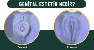 Genital estetik Kadınlar kulübü doktor takvimi doktorumsun en iyi lazerle rahim genital klitoris vajina dış iç dudak labium labioplasti labiaplasty labioplasty vajinoplasti daraltma beyazlatma sıkılaştırma PRP ozon orgasm orgazm G noktası G spot G shot O noktası O spot O shot dolgusu aşısı gençleştirme rejuveneation sarkması sarkıklığı küçültme küçültülmesi dolgusu dolgunlaştırma estetik estetiği ameliyatı lazerle tedavisi şekiller çeşitleri izi fiyat fiyatı fiyatları ücret ücreti ücretleri yaptıranlar yorumlar yaptıranların yorumları kadınlar kulübü ekşi before after öncesi sonrası resim fotoğraf video izle randevu veren yapan bay erkek bayan kadın doktor doktorlar hastane hastaneler hastanesi klinik klinikler kliniği 2019 2020 2021 2022 2023 ucuz en uygun hesaplı fiyat fiyatları fiyatı fiyatlı ücret ücreti ücretleri maliyet maliyeti rakam rakamları neden ne kadar nedir nasıl yapılır İstanbul’da İstanbul Avrupa yakası Anadolu yakası Türkiye, Adana, Adıyaman, Afyonkarahisar, Ağrı, Aksaray, Amasya, Ankara, Antalya, Ardahan, Artvin, Aydın, Balıkesir, Bartın, Batman, Bayburt, Bilecik, Bingöl, Bitlis, Bolu, Burdur, Bursa, Çanakkale, Çankırı, Çorum, Denizli, Diyarbakır, Düzce, Edirne, Elazığ, Erzincan, Erzurum, Eskişehir, Gaziantep, Giresun, Gümüşhane, Hakkâri, Hatay, Iğdır, Isparta, İstanbul, İzmir, Kahramanmaraş, Karabük, Karaman, Kars, Kastamonu, Kayseri, Kilis, Kırıkkale, Kırklareli, Kırşehir, Kocaeli, Konya, Kütahya, Malatya, Manisa, Mardin, Mersin, Muğla, Muş, Nevşehir, Niğde, Ordu, Osmaniye, Rize, Sakarya, Samsun, Şanlıurfa, Siirt, Sinop, Sivas, Şırnak, Tekirdağ, Tokat, Trabzon, Tunceli, Uşak, Van, Yalova, Yozgat, Zonguldak, Karaman, Fethiye, Bodrum, Adalar, Arnavutköy, Ataşehir, Avcılar, Bağcılar, Bahçelievler, Bakırköy, Başakşehir, Bayrampaşa, Beşiktaş, Beykoz, Beylikdüzü, Beyoğlu, Büyükçekmece, Çatalca, Çekmeköy, Esenler, Esenyurt, Eyüp, Fatih, Gaziosmanpaşa, Güngören, Kadıköy, Kağıthane, Kartal, Küçükçekmece, Maltepe, Pendik, Sancaktepe, Sarıyer, Silivri, Sultanbeyli, Sultangazi, Şile, Şişli, Tuzla, Ümraniye, Üsküdar, Zeytinburnu, Şişli, Nişantaşı, Mecidiyeköy, Acıbadem, Gebze, Çorlu, Tarsus, Viranşehir Kadınlar kulübü doktor takvimi doktorumsun en iyi lazerle rahim genital vajina klitoris dış iç dudak labium labioplasti labiaplasty labioplasty vajinoplasti daraltma beyazlatma sıkılaştırma PRP ozon orgasm orgazm G noktası G spot G shot O noktası O spot O shot dolgusu aşısı gençleştirme rejuveneation sarkması sarkıklığı küçültme küçültülmesi dolgusu dolgunlaştırma estetik estetiği ameliyatı lazerle tedavisi şekiller çeşitleri izi fiyat fiyatı fiyatları ücret ücreti ücretleri yaptıranlar yorumlar yaptıranların yorumları kadınlar kulübü ekşi before after öncesi sonrası resim fotoğraf video izle randevu veren yapan bay erkek bayan kadın doktor doktorlar hastane hastaneler hastanesi klinik klinikler kliniği 2019 2020 2021 2022 2023 ucuz en uygun hesaplı fiyat fiyatları fiyatı fiyatlı ücret ücreti ücretleri maliyet maliyeti rakam rakamları neden ne kadar nedir nasıl yapılır Türkiye, Adana, Adıyaman, Afyonkarahisar, Ağrı, Aksaray, Amasya, Ankara, Antalya, Ardahan, Artvin, Aydın, Balıkesir, Bartın, Batman, Bayburt, Bilecik, Bingöl, Bitlis, Bolu, Burdur, Bursa, Çanakkale, Çankırı, Çorum, Denizli, Diyarbakır, Düzce, Edirne, Elazığ, Erzincan, Erzurum, Eskişehir, Gaziantep, Giresun, Gümüşhane, Hakkâri, Hatay, Iğdır, Isparta, İstanbul, İzmir, Kahramanmaraş, Karabük, Karaman, Kars, Kastamonu, Kayseri, Kilis, Kırıkkale, Kırklareli, Kırşehir, Kocaeli, Konya, Kütahya, Malatya, Manisa, Mardin, Mersin, Muğla, Muş, Nevşehir, Niğde, Ordu, Osmaniye, Rize, Sakarya, Samsun, Şanlıurfa, Siirt, Sinop, Sivas, Şırnak, Tekirdağ, Tokat, Trabzon, Tunceli, Uşak, Van, Yalova, Yozgat, Zonguldak, Karaman, Fethiye, Bodrum, Adalar, Arnavutköy, Ataşehir, Avcılar, Bağcılar, Bahçelievler, Bakırköy, Başakşehir, Bayrampaşa, Beşiktaş, Beykoz, Beylikdüzü, Beyoğlu, Büyükçekmece, Çatalca, Çekmeköy, Esenler, Esenyurt, Eyüp, Fatih, Gaziosmanpaşa, Güngören, Kadıköy, Kağıthane, Kartal, Küçükçekmece, Maltepe, Pendik, Sancaktepe, Sarıyer, Silivri, Sultanbeyli, Sultangazi, Şile, Şişli, Tuzla, Ümraniye, Üsküdar, Zeytinburnu, Şişli, Nişantaşı, Mecidiyeköy, Acıbadem, Gebze, Çorlu, Tarsus, Viranşehir, İstanbul Avrupa yakası Anadolu yakası Kadınlar kulübü doktor takvimi doktorumsun en iyi lazerle rahim genital vajina klitoris dış iç dudak labium labioplasti labiaplasty labioplasty vajinoplasti daraltma beyazlatma sıkılaştırma PRP ozon orgasm orgazm G noktası G spot G shot O noktası O spot O shot dolgusu aşısı gençleştirme rejuveneation sarkması sarkıklığı küçültme küçültülmesi dolgusu dolgunlaştırma estetik estetiği ameliyatı lazerle tedavisi şekiller çeşitleri izi fiyat fiyatı fiyatları ücret ücreti ücretleri yaptıranlar yorumlar yaptıranların yorumları kadınlar kulübü ekşi before after öncesi sonrası resim fotoğraf video izle randevu veren yapan bay erkek bayan kadın doktor doktorlar hastane hastaneler hastanesi klinik klinikler kliniği 2019 2020 2021 2022 2023 ucuz en uygun hesaplı fiyat fiyatları fiyatı fiyatlı ücret ücreti ücretleri maliyet maliyeti rakam rakamları neden ne kadar nedir nasıl yapılır.