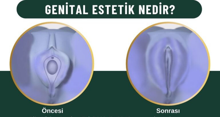 Genital estetik Kadınlar kulübü doktor takvimi doktorumsun en iyi lazerle rahim genital klitoris vajina dış iç dudak labium labioplasti labiaplasty labioplasty vajinoplasti daraltma beyazlatma sıkılaştırma PRP ozon orgasm orgazm G noktası G spot G shot O noktası O spot O shot dolgusu aşısı gençleştirme rejuveneation sarkması sarkıklığı küçültme küçültülmesi dolgusu dolgunlaştırma estetik estetiği ameliyatı lazerle tedavisi şekiller çeşitleri izi fiyat fiyatı fiyatları ücret ücreti ücretleri yaptıranlar yorumlar yaptıranların yorumları kadınlar kulübü ekşi before after öncesi sonrası resim fotoğraf video izle randevu veren yapan bay erkek bayan kadın doktor doktorlar hastane hastaneler hastanesi klinik klinikler kliniği 2019 2020 2021 2022 2023 ucuz en uygun hesaplı fiyat fiyatları fiyatı fiyatlı ücret ücreti ücretleri maliyet maliyeti rakam rakamları neden ne kadar nedir nasıl yapılır İstanbul’da İstanbul Avrupa yakası Anadolu yakası Türkiye, Adana, Adıyaman, Afyonkarahisar, Ağrı, Aksaray, Amasya, Ankara, Antalya, Ardahan, Artvin, Aydın, Balıkesir, Bartın, Batman, Bayburt, Bilecik, Bingöl, Bitlis, Bolu, Burdur, Bursa, Çanakkale, Çankırı, Çorum, Denizli, Diyarbakır, Düzce, Edirne, Elazığ, Erzincan, Erzurum, Eskişehir, Gaziantep, Giresun, Gümüşhane, Hakkâri, Hatay, Iğdır, Isparta, İstanbul, İzmir, Kahramanmaraş, Karabük, Karaman, Kars, Kastamonu, Kayseri, Kilis, Kırıkkale, Kırklareli, Kırşehir, Kocaeli, Konya, Kütahya, Malatya, Manisa, Mardin, Mersin, Muğla, Muş, Nevşehir, Niğde, Ordu, Osmaniye, Rize, Sakarya, Samsun, Şanlıurfa, Siirt, Sinop, Sivas, Şırnak, Tekirdağ, Tokat, Trabzon, Tunceli, Uşak, Van, Yalova, Yozgat, Zonguldak, Karaman, Fethiye, Bodrum, Adalar, Arnavutköy, Ataşehir, Avcılar, Bağcılar, Bahçelievler, Bakırköy, Başakşehir, Bayrampaşa, Beşiktaş, Beykoz, Beylikdüzü, Beyoğlu, Büyükçekmece, Çatalca, Çekmeköy, Esenler, Esenyurt, Eyüp, Fatih, Gaziosmanpaşa, Güngören, Kadıköy, Kağıthane, Kartal, Küçükçekmece, Maltepe, Pendik, Sancaktepe, Sarıyer, Silivri, Sultanbeyli, Sultangazi, Şile, Şişli, Tuzla, Ümraniye, Üsküdar, Zeytinburnu, Şişli, Nişantaşı, Mecidiyeköy, Acıbadem, Gebze, Çorlu, Tarsus, Viranşehir Kadınlar kulübü doktor takvimi doktorumsun en iyi lazerle rahim genital vajina klitoris dış iç dudak labium labioplasti labiaplasty labioplasty vajinoplasti daraltma beyazlatma sıkılaştırma PRP ozon orgasm orgazm G noktası G spot G shot O noktası O spot O shot dolgusu aşısı gençleştirme rejuveneation sarkması sarkıklığı küçültme küçültülmesi dolgusu dolgunlaştırma estetik estetiği ameliyatı lazerle tedavisi şekiller çeşitleri izi fiyat fiyatı fiyatları ücret ücreti ücretleri yaptıranlar yorumlar yaptıranların yorumları kadınlar kulübü ekşi before after öncesi sonrası resim fotoğraf video izle randevu veren yapan bay erkek bayan kadın doktor doktorlar hastane hastaneler hastanesi klinik klinikler kliniği 2019 2020 2021 2022 2023 ucuz en uygun hesaplı fiyat fiyatları fiyatı fiyatlı ücret ücreti ücretleri maliyet maliyeti rakam rakamları neden ne kadar nedir nasıl yapılır Türkiye, Adana, Adıyaman, Afyonkarahisar, Ağrı, Aksaray, Amasya, Ankara, Antalya, Ardahan, Artvin, Aydın, Balıkesir, Bartın, Batman, Bayburt, Bilecik, Bingöl, Bitlis, Bolu, Burdur, Bursa, Çanakkale, Çankırı, Çorum, Denizli, Diyarbakır, Düzce, Edirne, Elazığ, Erzincan, Erzurum, Eskişehir, Gaziantep, Giresun, Gümüşhane, Hakkâri, Hatay, Iğdır, Isparta, İstanbul, İzmir, Kahramanmaraş, Karabük, Karaman, Kars, Kastamonu, Kayseri, Kilis, Kırıkkale, Kırklareli, Kırşehir, Kocaeli, Konya, Kütahya, Malatya, Manisa, Mardin, Mersin, Muğla, Muş, Nevşehir, Niğde, Ordu, Osmaniye, Rize, Sakarya, Samsun, Şanlıurfa, Siirt, Sinop, Sivas, Şırnak, Tekirdağ, Tokat, Trabzon, Tunceli, Uşak, Van, Yalova, Yozgat, Zonguldak, Karaman, Fethiye, Bodrum, Adalar, Arnavutköy, Ataşehir, Avcılar, Bağcılar, Bahçelievler, Bakırköy, Başakşehir, Bayrampaşa, Beşiktaş, Beykoz, Beylikdüzü, Beyoğlu, Büyükçekmece, Çatalca, Çekmeköy, Esenler, Esenyurt, Eyüp, Fatih, Gaziosmanpaşa, Güngören, Kadıköy, Kağıthane, Kartal, Küçükçekmece, Maltepe, Pendik, Sancaktepe, Sarıyer, Silivri, Sultanbeyli, Sultangazi, Şile, Şişli, Tuzla, Ümraniye, Üsküdar, Zeytinburnu, Şişli, Nişantaşı, Mecidiyeköy, Acıbadem, Gebze, Çorlu, Tarsus, Viranşehir, İstanbul Avrupa yakası Anadolu yakası Kadınlar kulübü doktor takvimi doktorumsun en iyi lazerle rahim genital vajina klitoris dış iç dudak labium labioplasti labiaplasty labioplasty vajinoplasti daraltma beyazlatma sıkılaştırma PRP ozon orgasm orgazm G noktası G spot G shot O noktası O spot O shot dolgusu aşısı gençleştirme rejuveneation sarkması sarkıklığı küçültme küçültülmesi dolgusu dolgunlaştırma estetik estetiği ameliyatı lazerle tedavisi şekiller çeşitleri izi fiyat fiyatı fiyatları ücret ücreti ücretleri yaptıranlar yorumlar yaptıranların yorumları kadınlar kulübü ekşi before after öncesi sonrası resim fotoğraf video izle randevu veren yapan bay erkek bayan kadın doktor doktorlar hastane hastaneler hastanesi klinik klinikler kliniği 2019 2020 2021 2022 2023 ucuz en uygun hesaplı fiyat fiyatları fiyatı fiyatlı ücret ücreti ücretleri maliyet maliyeti rakam rakamları neden ne kadar nedir nasıl yapılır.