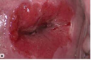Siğil Kadınlar kulübü doktor takvimi doktorumsun en iyi lazerle rahim genital bikini bölgesi el ayak anal anogenital smear testi sonucu tipleri ilaçla ameliyatsız lazer ile dondurma yakma tedavi tedavisi vajina siğil siğili siğilleri kondilom HPV aşısı kolposkopi rahim ağzı yara yarası tedavisi kanama erezyon kanser kanseri patoloji biyopsi sonucu başlangıcı ameliyatı lazerle şekiller çeşitleri izi fiyat fiyatı fiyatları ücret ücreti ücretleri yaptıranlar yorumlar yaptıranların yorumları kadınlar kulübü 2019 2020 2021 2022 2023 ucuz en uygun hesaplı fiyat fiyatları fiyatı fiyatlı ücret ücreti ücretleri maliyet maliyeti rakam rakamları ekşi before after öncesi sonrası ağrı ağrısı kanama kanaması süre süresi iyileşme his kaybı resim fotoğraf video izle randevu veren yapan özel devlet hastanesi hastane hastaneler bayan kadın doktor doktorlar klinik klinikler kliniği neden ne kadar nedir nasıl yapılır İstanbul’da İstanbul Avrupa yakası Anadolu yakası Türkiye, Adana, Adıyaman, Afyonkarahisar, Ağrı, Aksaray, Amasya, Ankara, Antalya, Ardahan, Artvin, Aydın, Balıkesir, Bartın, Batman, Bayburt, Bilecik, Bingöl, Bitlis, Bolu, Burdur, Bursa, Çanakkale, Çankırı, Çorum, Denizli, Diyarbakır, Düzce, Edirne, Elazığ, Erzincan, Erzurum, Eskişehir, Gaziantep, Giresun, Gümüşhane, Hakkâri, Hatay, Iğdır, Isparta, İstanbul, İzmir, Kahramanmaraş, Karabük, Karaman, Kars, Kastamonu, Kayseri, Kilis, Kırıkkale, Kırklareli, Kırşehir, Kocaeli, Konya, Kütahya, Malatya, Manisa, Mardin, Mersin, Muğla, Muş, Nevşehir, Niğde, Ordu, Osmaniye, Rize, Sakarya, Samsun, Şanlıurfa, Siirt, Sinop, Sivas, Şırnak, Tekirdağ, Tokat, Trabzon, Tunceli, Uşak, Van, Yalova, Yozgat, Zonguldak, Karaman, Fethiye, Bodrum, Adalar, Arnavutköy, Ataşehir, Avcılar, Bağcılar, Bahçelievler, Bakırköy, Başakşehir, Bayrampaşa, Beşiktaş, Beykoz, Beylikdüzü, Beyoğlu, Büyükçekmece, Çatalca, Çekmeköy, Esenler, Esenyurt, Eyüp, Fatih, Gaziosmanpaşa, Güngören, Kadıköy, Kağıthane, Kartal, Küçükçekmece, Maltepe, Pendik, Sancaktepe, Sarıyer, Silivri, Sultanbeyli, Sultangazi, Şile, Şişli, Tuzla, Ümraniye, Üsküdar, Zeytinburnu, Şişli, Nişantaşı, Mecidiyeköy, Acıbadem, Gebze, Çorlu, Tarsus, Viranşehir Kadınlar kulübü doktor takvimi doktorumsun en iyi lazerle rahim genital bikini bölgesi el ayak anal anogenital smear testi sonucu tipleri ilaçla ameliyatsız lazer ile dondurma yakma tedavi tedavisi vajina siğil siğili siğilleri kondilom HPV aşısı kolposkopi rahim ağzı yara yarası tedavisi kanama erezyon kanser kanseri patoloji biyopsi sonucu başlangıcı ameliyatı lazerle şekiller çeşitleri izi fiyat fiyatı fiyatları ücret ücreti ücretleri yaptıranlar yorumlar yaptıranların yorumları kadınlar kulübü 2019 2020 2021 2022 2023 ucuz en uygun hesaplı fiyat fiyatları fiyatı fiyatlı ücret ücreti ücretleri maliyet maliyeti rakam rakamları ekşi before after öncesi sonrası ağrı ağrısı kanama kanaması süre süresi iyileşme his kaybı resim fotoğraf video izle randevu veren yapan özel devlet hastanesi hastane hastaneler bayan kadın doktor doktorlar klinik klinikler kliniği neden ne kadar nedir nasıl yapılır Türkiye, Adana, Adıyaman, Afyonkarahisar, Ağrı, Aksaray, Amasya, Ankara, Antalya, Ardahan, Artvin, Aydın, Balıkesir, Bartın, Batman, Bayburt, Bilecik, Bingöl, Bitlis, Bolu, Burdur, Bursa, Çanakkale, Çankırı, Çorum, Denizli, Diyarbakır, Düzce, Edirne, Elazığ, Erzincan, Erzurum, Eskişehir, Gaziantep, Giresun, Gümüşhane, Hakkâri, Hatay, Iğdır, Isparta, İstanbul, İzmir, Kahramanmaraş, Karabük, Karaman, Kars, Kastamonu, Kayseri, Kilis, Kırıkkale, Kırklareli, Kırşehir, Kocaeli, Konya, Kütahya, Malatya, Manisa, Mardin, Mersin, Muğla, Muş, Nevşehir, Niğde, Ordu, Osmaniye, Rize, Sakarya, Samsun, Şanlıurfa, Siirt, Sinop, Sivas, Şırnak, Tekirdağ, Tokat, Trabzon, Tunceli, Uşak, Van, Yalova, Yozgat, Zonguldak, Karaman, Fethiye, Bodrum, Adalar, Arnavutköy, Ataşehir, Avcılar, Bağcılar, Bahçelievler, Bakırköy, Başakşehir, Bayrampaşa, Beşiktaş, Beykoz, Beylikdüzü, Beyoğlu, Büyükçekmece, Çatalca, Çekmeköy, Esenler, Esenyurt, Eyüp, Fatih, Gaziosmanpaşa, Güngören, Kadıköy, Kağıthane, Kartal, Küçükçekmece, Maltepe, Pendik, Sancaktepe, Sarıyer, Silivri, Sultanbeyli, Sultangazi, Şile, Şişli, Tuzla, Ümraniye, Üsküdar, Zeytinburnu, Şişli, Nişantaşı, Mecidiyeköy, Acıbadem, Gebze, Çorlu, Tarsus, Viranşehir, İstanbul Avrupa yakası Anadolu yakası Kadınlar kulübü doktor takvimi doktorumsun en iyi lazerle rahim genital bikini bölgesi el ayak anal anogenital smear testi sonucu tipleri ilaçla ameliyatsız lazer ile dondurma yakma tedavi tedavisi vajina siğil siğili siğilleri kondilom HPV aşısı kolposkopi rahim ağzı yara yarası tedavisi kanama erezyon kanser kanseri patoloji biyopsi sonucu başlangıcı ameliyatı lazerle şekiller çeşitleri izi fiyat fiyatı fiyatları ücret ücreti ücretleri yaptıranlar yorumlar yaptıranların yorumları kadınlar kulübü 2019 2020 2021 2022 2023 2024 ucuz en uygun hesaplı fiyat fiyatları fiyatı fiyatlı ücret ücreti ücretleri maliyet maliyeti rakam rakamları ekşi before after öncesi sonrası ağrı ağrısı kanama kanaması süre süresi iyileşme his kaybı resim fotoğraf video izle randevu veren yapan özel devlet hastanesi hastane hastaneler bayan kadın doktor doktorlar klinik klinikler kliniği neden ne kadar nedir nasıl yapılır.