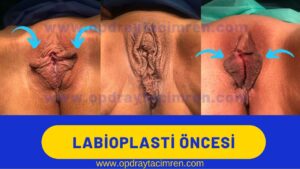 iç dudak estetiği genital estetik labioplasti öncesi sonrası