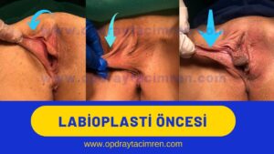 iç dudak estetiği genital estetik labioplasti öncesi sonrası