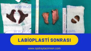 iç dudak estetiği genital estetik labioplasti öncesi sonrası