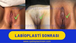 iç dudak estetiği genital estetik labioplasti öncesi sonrası