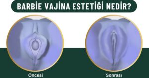 Barbie vajina estetiği Kadınlar kulübü doktor takvimi doktorumsun en iyi lazerle rahim genital klitoris barbie vajina estetiği dış iç dudak labium labioplasti labiaplasty labioplasty vajinoplasti daraltma beyazlatma sıkılaştırma PRP ozon orgasm orgazm G noktası G spot G shot O noktası O spot O shot dolgusu aşısı gençleştirme rejuveneation rejuvenasyon sarkması sarkıklığı küçültme küçültülmesi dolgusu dolgunlaştırma estetik estetiği ameliyatı lazerle tedavisi şekiller çeşitleri izi fiyat fiyatı fiyatları ücret ücreti ücretleri yaptıranlar yorumlar yaptıranların yorumları kadınlar kulübü ekşi before after öncesi sonrası resim fotoğraf video izle randevu veren yapan bay erkek bayan kadın doktor doktorlar hastane hastaneler hastanesi klinik klinikler kliniği 2019 2020 2021 2022 2023 ucuz en uygun hesaplı fiyat fiyatları fiyatı fiyatlı ücret ücreti ücretleri maliyet maliyeti rakam rakamları neden ne kadar nedir nasıl yapılır İstanbul’da İstanbul Avrupa yakası Anadolu yakası Türkiye, Adana, Adıyaman, Afyonkarahisar, Ağrı, Aksaray, Amasya, Ankara, Antalya, Ardahan, Artvin, Aydın, Balıkesir, Bartın, Batman, Bayburt, Bilecik, Bingöl, Bitlis, Bolu, Burdur, Bursa, Çanakkale, Çankırı, Çorum, Denizli, Diyarbakır, Düzce, Edirne, Elazığ, Erzincan, Erzurum, Eskişehir, Gaziantep, Giresun, Gümüşhane, Hakkâri, Hatay, Iğdır, Isparta, İstanbul, İzmir, Kahramanmaraş, Karabük, Karaman, Kars, Kastamonu, Kayseri, Kilis, Kırıkkale, Kırklareli, Kırşehir, Kocaeli, Konya, Kütahya, Malatya, Manisa, Mardin, Mersin, Muğla, Muş, Nevşehir, Niğde, Ordu, Osmaniye, Rize, Sakarya, Samsun, Şanlıurfa, Siirt, Sinop, Sivas, Şırnak, Tekirdağ, Tokat, Trabzon, Tunceli, Uşak, Van, Yalova, Yozgat, Zonguldak, Karaman, Fethiye, Bodrum, Adalar, Arnavutköy, Ataşehir, Avcılar, Bağcılar, Bahçelievler, Bakırköy, Başakşehir, Bayrampaşa, Beşiktaş, Beykoz, Beylikdüzü, Beyoğlu, Büyükçekmece, Çatalca, Çekmeköy, Esenler, Esenyurt, Eyüp, Fatih, Gaziosmanpaşa, Güngören, Kadıköy, Kağıthane, Kartal, Küçükçekmece, Maltepe, Pendik, Sancaktepe, Sarıyer, Silivri, Sultanbeyli, Sultangazi, Şile, Şişli, Tuzla, Ümraniye, Üsküdar, Zeytinburnu, Şişli, Nişantaşı, Mecidiyeköy, Acıbadem, Gebze, Çorlu, Tarsus, Viranşehir Kadınlar kulübü doktor takvimi doktorumsun en iyi lazerle rahim genital barbie vajina estetiği klitoris dış iç dudak labium labioplasti labiaplasty labioplasty vajinoplasti daraltma beyazlatma sıkılaştırma PRP ozon orgasm orgazm G noktası G spot G shot O noktası O spot O shot dolgusu aşısı gençleştirme rejuveneation rejuvenasyon sarkması sarkıklığı küçültme küçültülmesi dolgusu dolgunlaştırma estetik estetiği ameliyatı lazerle tedavisi şekiller çeşitleri izi fiyat fiyatı fiyatları ücret ücreti ücretleri yaptıranlar yorumlar yaptıranların yorumları kadınlar kulübü ekşi before after öncesi sonrası resim fotoğraf video izle randevu veren yapan bay erkek bayan kadın doktor doktorlar hastane hastaneler hastanesi klinik klinikler kliniği 2019 2020 2021 2022 2023 ucuz en uygun hesaplı fiyat fiyatları fiyatı fiyatlı ücret ücreti ücretleri maliyet maliyeti rakam rakamları neden ne kadar nedir nasıl yapılır Türkiye, Adana, Adıyaman, Afyonkarahisar, Ağrı, Aksaray, Amasya, Ankara, Antalya, Ardahan, Artvin, Aydın, Balıkesir, Bartın, Batman, Bayburt, Bilecik, Bingöl, Bitlis, Bolu, Burdur, Bursa, Çanakkale, Çankırı, Çorum, Denizli, Diyarbakır, Düzce, Edirne, Elazığ, Erzincan, Erzurum, Eskişehir, Gaziantep, Giresun, Gümüşhane, Hakkâri, Hatay, Iğdır, Isparta, İstanbul, İzmir, Kahramanmaraş, Karabük, Karaman, Kars, Kastamonu, Kayseri, Kilis, Kırıkkale, Kırklareli, Kırşehir, Kocaeli, Konya, Kütahya, Malatya, Manisa, Mardin, Mersin, Muğla, Muş, Nevşehir, Niğde, Ordu, Osmaniye, Rize, Sakarya, Samsun, Şanlıurfa, Siirt, Sinop, Sivas, Şırnak, Tekirdağ, Tokat, Trabzon, Tunceli, Uşak, Van, Yalova, Yozgat, Zonguldak, Karaman, Fethiye, Bodrum, Adalar, Arnavutköy, Ataşehir, Avcılar, Bağcılar, Bahçelievler, Bakırköy, Başakşehir, Bayrampaşa, Beşiktaş, Beykoz, Beylikdüzü, Beyoğlu, Büyükçekmece, Çatalca, Çekmeköy, Esenler, Esenyurt, Eyüp, Fatih, Gaziosmanpaşa, Güngören, Kadıköy, Kağıthane, Kartal, Küçükçekmece, Maltepe, Pendik, Sancaktepe, Sarıyer, Silivri, Sultanbeyli, Sultangazi, Şile, Şişli, Tuzla, Ümraniye, Üsküdar, Zeytinburnu, Şişli, Nişantaşı, Mecidiyeköy, Acıbadem, Gebze, Çorlu, Tarsus, Viranşehir, İstanbul Avrupa yakası Anadolu yakası Kadınlar kulübü doktor takvimi doktorumsun en iyi lazerle rahim genital barbie vajina estetiği klitoris dış iç dudak labium labioplasti labiaplasty labioplasty vajinoplasti daraltma beyazlatma sıkılaştırma PRP ozon orgasm orgazm G noktası G spot G shot O noktası O spot O shot dolgusu aşısı gençleştirme rejuveneation rejuvenasyon sarkması sarkıklığı küçültme küçültülmesi dolgusu dolgunlaştırma estetik estetiği ameliyatı lazerle tedavisi şekiller çeşitleri izi fiyat fiyatı fiyatları ücret ücreti ücretleri yaptıranlar yorumlar yaptıranların yorumları kadınlar kulübü ekşi before after öncesi sonrası resim fotoğraf video izle randevu veren yapan bay erkek bayan kadın doktor doktorlar hastane hastaneler hastanesi klinik klinikler kliniği 2019 2020 2021 2022 2023 ucuz en uygun hesaplı fiyat fiyatları fiyatı fiyatlı ücret ücreti ücretleri maliyet maliyeti rakam rakamları neden ne kadar nedir nasıl yapılır.