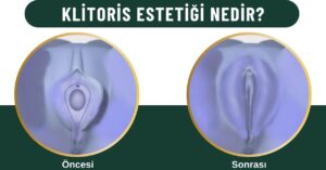 Klitoris estetiği Kadınlar kulübü doktor takvimi doktorumsun en iyi lazerle rahim genital klitoris estetiği hudoplasti kudoplasti huudoplasti vajina dış iç dudak labium labioplasti labiaplasty labioplasty vajinoplasti daraltma beyazlatma sıkılaştırma PRP ozon orgasm orgazm G noktası G spot G shot O noktası O spot O shot dolgusu aşısı gençleştirme rejuveneation sarkması sarkıklığı küçültme küçültülmesi dolgusu dolgunlaştırma estetik estetiği ameliyatı lazerle tedavisi şekiller çeşitleri izi fiyat fiyatı fiyatları ücret ücreti ücretleri yaptıranlar yorumlar yaptıranların yorumları kadınlar kulübü ekşi before after öncesi sonrası ağrı kanama süresi iyileşme resim fotoğraf video izle randevu veren yapan bay erkek bayan kadın doktor doktorlar hastane hastaneler hastanesi klinik klinikler kliniği 2019 2020 2021 2022 2023 ucuz en uygun hesaplı fiyat fiyatları fiyatı fiyatlı ücret ücreti ücretleri maliyet maliyeti rakam rakamları neden ne kadar nedir nasıl yapılır İstanbul’da İstanbul Avrupa yakası Anadolu yakası Türkiye, Adana, Adıyaman, Afyonkarahisar, Ağrı, Aksaray, Amasya, Ankara, Antalya, Ardahan, Artvin, Aydın, Balıkesir, Bartın, Batman, Bayburt, Bilecik, Bingöl, Bitlis, Bolu, Burdur, Bursa, Çanakkale, Çankırı, Çorum, Denizli, Diyarbakır, Düzce, Edirne, Elazığ, Erzincan, Erzurum, Eskişehir, Gaziantep, Giresun, Gümüşhane, Hakkâri, Hatay, Iğdır, Isparta, İstanbul, İzmir, Kahramanmaraş, Karabük, Karaman, Kars, Kastamonu, Kayseri, Kilis, Kırıkkale, Kırklareli, Kırşehir, Kocaeli, Konya, Kütahya, Malatya, Manisa, Mardin, Mersin, Muğla, Muş, Nevşehir, Niğde, Ordu, Osmaniye, Rize, Sakarya, Samsun, Şanlıurfa, Siirt, Sinop, Sivas, Şırnak, Tekirdağ, Tokat, Trabzon, Tunceli, Uşak, Van, Yalova, Yozgat, Zonguldak, Karaman, Fethiye, Bodrum, Adalar, Arnavutköy, Ataşehir, Avcılar, Bağcılar, Bahçelievler, Bakırköy, Başakşehir, Bayrampaşa, Beşiktaş, Beykoz, Beylikdüzü, Beyoğlu, Büyükçekmece, Çatalca, Çekmeköy, Esenler, Esenyurt, Eyüp, Fatih, Gaziosmanpaşa, Güngören, Kadıköy, Kağıthane, Kartal, Küçükçekmece, Maltepe, Pendik, Sancaktepe, Sarıyer, Silivri, Sultanbeyli, Sultangazi, Şile, Şişli, Tuzla, Ümraniye, Üsküdar, Zeytinburnu, Şişli, Nişantaşı, Mecidiyeköy, Acıbadem, Gebze, Çorlu, Tarsus, Viranşehir Kadınlar kulübü doktor takvimi doktorumsun en iyi lazerle rahim genital vajina klitoris estetiği hudoplasti kudoplasti huudoplasti dış iç dudak labium labioplasti labiaplasty labioplasty vajinoplasti daraltma beyazlatma sıkılaştırma PRP ozon orgasm orgazm G noktası G spot G shot O noktası O spot O shot dolgusu aşısı gençleştirme rejuveneation sarkması sarkıklığı küçültme küçültülmesi dolgusu dolgunlaştırma estetik estetiği ameliyatı lazerle tedavisi şekiller çeşitleri izi fiyat fiyatı fiyatları ücret ücreti ücretleri yaptıranlar yorumlar yaptıranların yorumları kadınlar kulübü ekşi before after öncesi sonrası ağrı kanama süresi iyileşme resim fotoğraf video izle randevu veren yapan bay erkek bayan kadın doktor doktorlar hastane hastaneler hastanesi klinik klinikler kliniği 2019 2020 2021 2022 2023 ucuz en uygun hesaplı fiyat fiyatları fiyatı fiyatlı ücret ücreti ücretleri maliyet maliyeti rakam rakamları neden ne kadar nedir nasıl yapılır Türkiye, Adana, Adıyaman, Afyonkarahisar, Ağrı, Aksaray, Amasya, Ankara, Antalya, Ardahan, Artvin, Aydın, Balıkesir, Bartın, Batman, Bayburt, Bilecik, Bingöl, Bitlis, Bolu, Burdur, Bursa, Çanakkale, Çankırı, Çorum, Denizli, Diyarbakır, Düzce, Edirne, Elazığ, Erzincan, Erzurum, Eskişehir, Gaziantep, Giresun, Gümüşhane, Hakkâri, Hatay, Iğdır, Isparta, İstanbul, İzmir, Kahramanmaraş, Karabük, Karaman, Kars, Kastamonu, Kayseri, Kilis, Kırıkkale, Kırklareli, Kırşehir, Kocaeli, Konya, Kütahya, Malatya, Manisa, Mardin, Mersin, Muğla, Muş, Nevşehir, Niğde, Ordu, Osmaniye, Rize, Sakarya, Samsun, Şanlıurfa, Siirt, Sinop, Sivas, Şırnak, Tekirdağ, Tokat, Trabzon, Tunceli, Uşak, Van, Yalova, Yozgat, Zonguldak, Karaman, Fethiye, Bodrum, Adalar, Arnavutköy, Ataşehir, Avcılar, Bağcılar, Bahçelievler, Bakırköy, Başakşehir, Bayrampaşa, Beşiktaş, Beykoz, Beylikdüzü, Beyoğlu, Büyükçekmece, Çatalca, Çekmeköy, Esenler, Esenyurt, Eyüp, Fatih, Gaziosmanpaşa, Güngören, Kadıköy, Kağıthane, Kartal, Küçükçekmece, Maltepe, Pendik, Sancaktepe, Sarıyer, Silivri, Sultanbeyli, Sultangazi, Şile, Şişli, Tuzla, Ümraniye, Üsküdar, Zeytinburnu, Şişli, Nişantaşı, Mecidiyeköy, Acıbadem, Gebze, Çorlu, Tarsus, Viranşehir, İstanbul Avrupa yakası Anadolu yakası Kadınlar kulübü doktor takvimi doktorumsun en iyi lazerle rahim genital vajina klitoris estetiği hudoplasti kudoplasti huudoplasti dış iç dudak labium labioplasti labiaplasty labioplasty vajinoplasti daraltma beyazlatma sıkılaştırma PRP ozon orgasm orgazm G noktası G spot G shot O noktası O spot O shot dolgusu aşısı gençleştirme rejuveneation sarkması sarkıklığı küçültme küçültülmesi dolgusu dolgunlaştırma estetik estetiği ameliyatı lazerle tedavisi şekiller çeşitleri izi fiyat fiyatı fiyatları ücret ücreti ücretleri yaptıranlar yorumlar yaptıranların yorumları kadınlar kulübü ekşi before after öncesi sonrası ağrı kanama süresi iyileşme resim fotoğraf video izle randevu veren yapan bay erkek bayan kadın doktor doktorlar hastane hastaneler hastanesi klinik klinikler kliniği 2019 2020 2021 2022 2023 ucuz en uygun hesaplı fiyat fiyatları fiyatı fiyatlı ücret ücreti ücretleri maliyet maliyeti rakam rakamları neden ne kadar nedir nasıl yapılır.