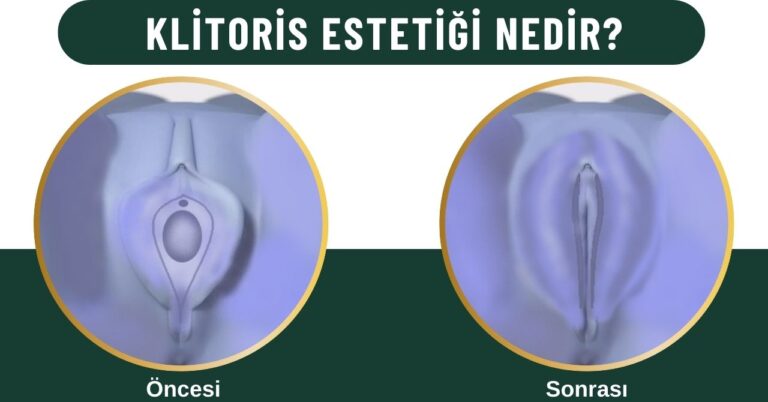 Klitoris Estetiği Hudoplasti - Klitoris Estetiği, hudoplasti - Op. Dr. Aytaç İMREN Klitoris estetiği Kadınlar kulübü doktor takvimi doktorumsun en iyi lazerle rahim genital klitoris estetiği hudoplasti kudoplasti huudoplasti vajina dış iç dudak labium labioplasti labiaplasty labioplasty vajinoplasti daraltma beyazlatma sıkılaştırma PRP ozon orgasm orgazm G noktası G spot G shot O noktası O spot O shot dolgusu aşısı gençleştirme rejuveneation sarkması sarkıklığı küçültme küçültülmesi dolgusu dolgunlaştırma estetik estetiği ameliyatı lazerle tedavisi şekiller çeşitleri izi fiyat fiyatı fiyatları ücret ücreti ücretleri yaptıranlar yorumlar yaptıranların yorumları kadınlar kulübü ekşi before after öncesi sonrası ağrı kanama süresi iyileşme resim fotoğraf video izle randevu veren yapan bay erkek bayan kadın doktor doktorlar hastane hastaneler hastanesi klinik klinikler kliniği 2019 2020 2021 2022 2023 ucuz en uygun hesaplı fiyat fiyatları fiyatı fiyatlı ücret ücreti ücretleri maliyet maliyeti rakam rakamları neden ne kadar nedir nasıl yapılır İstanbul’da İstanbul Avrupa yakası Anadolu yakası Türkiye, Adana, Adıyaman, Afyonkarahisar, Ağrı, Aksaray, Amasya, Ankara, Antalya, Ardahan, Artvin, Aydın, Balıkesir, Bartın, Batman, Bayburt, Bilecik, Bingöl, Bitlis, Bolu, Burdur, Bursa, Çanakkale, Çankırı, Çorum, Denizli, Diyarbakır, Düzce, Edirne, Elazığ, Erzincan, Erzurum, Eskişehir, Gaziantep, Giresun, Gümüşhane, Hakkâri, Hatay, Iğdır, Isparta, İstanbul, İzmir, Kahramanmaraş, Karabük, Karaman, Kars, Kastamonu, Kayseri, Kilis, Kırıkkale, Kırklareli, Kırşehir, Kocaeli, Konya, Kütahya, Malatya, Manisa, Mardin, Mersin, Muğla, Muş, Nevşehir, Niğde, Ordu, Osmaniye, Rize, Sakarya, Samsun, Şanlıurfa, Siirt, Sinop, Sivas, Şırnak, Tekirdağ, Tokat, Trabzon, Tunceli, Uşak, Van, Yalova, Yozgat, Zonguldak, Karaman, Fethiye, Bodrum, Adalar, Arnavutköy, Ataşehir, Avcılar, Bağcılar, Bahçelievler, Bakırköy, Başakşehir, Bayrampaşa, Beşiktaş, Beykoz, Beylikdüzü, Beyoğlu, Büyükçekmece, Çatalca, Çekmeköy, Esenler, Esenyurt, Eyüp, Fatih, Gaziosmanpaşa, Güngören, Kadıköy, Kağıthane, Kartal, Küçükçekmece, Maltepe, Pendik, Sancaktepe, Sarıyer, Silivri, Sultanbeyli, Sultangazi, Şile, Şişli, Tuzla, Ümraniye, Üsküdar, Zeytinburnu, Şişli, Nişantaşı, Mecidiyeköy, Acıbadem, Gebze, Çorlu, Tarsus, Viranşehir Kadınlar kulübü doktor takvimi doktorumsun en iyi lazerle rahim genital vajina klitoris estetiği hudoplasti kudoplasti huudoplasti dış iç dudak labium labioplasti labiaplasty labioplasty vajinoplasti daraltma beyazlatma sıkılaştırma PRP ozon orgasm orgazm G noktası G spot G shot O noktası O spot O shot dolgusu aşısı gençleştirme rejuveneation sarkması sarkıklığı küçültme küçültülmesi dolgusu dolgunlaştırma estetik estetiği ameliyatı lazerle tedavisi şekiller çeşitleri izi fiyat fiyatı fiyatları ücret ücreti ücretleri yaptıranlar yorumlar yaptıranların yorumları kadınlar kulübü ekşi before after öncesi sonrası ağrı kanama süresi iyileşme resim fotoğraf video izle randevu veren yapan bay erkek bayan kadın doktor doktorlar hastane hastaneler hastanesi klinik klinikler kliniği 2019 2020 2021 2022 2023 ucuz en uygun hesaplı fiyat fiyatları fiyatı fiyatlı ücret ücreti ücretleri maliyet maliyeti rakam rakamları neden ne kadar nedir nasıl yapılır Türkiye, Adana, Adıyaman, Afyonkarahisar, Ağrı, Aksaray, Amasya, Ankara, Antalya, Ardahan, Artvin, Aydın, Balıkesir, Bartın, Batman, Bayburt, Bilecik, Bingöl, Bitlis, Bolu, Burdur, Bursa, Çanakkale, Çankırı, Çorum, Denizli, Diyarbakır, Düzce, Edirne, Elazığ, Erzincan, Erzurum, Eskişehir, Gaziantep, Giresun, Gümüşhane, Hakkâri, Hatay, Iğdır, Isparta, İstanbul, İzmir, Kahramanmaraş, Karabük, Karaman, Kars, Kastamonu, Kayseri, Kilis, Kırıkkale, Kırklareli, Kırşehir, Kocaeli, Konya, Kütahya, Malatya, Manisa, Mardin, Mersin, Muğla, Muş, Nevşehir, Niğde, Ordu, Osmaniye, Rize, Sakarya, Samsun, Şanlıurfa, Siirt, Sinop, Sivas, Şırnak, Tekirdağ, Tokat, Trabzon, Tunceli, Uşak, Van, Yalova, Yozgat, Zonguldak, Karaman, Fethiye, Bodrum, Adalar, Arnavutköy, Ataşehir, Avcılar, Bağcılar, Bahçelievler, Bakırköy, Başakşehir, Bayrampaşa, Beşiktaş, Beykoz, Beylikdüzü, Beyoğlu, Büyükçekmece, Çatalca, Çekmeköy, Esenler, Esenyurt, Eyüp, Fatih, Gaziosmanpaşa, Güngören, Kadıköy, Kağıthane, Kartal, Küçükçekmece, Maltepe, Pendik, Sancaktepe, Sarıyer, Silivri, Sultanbeyli, Sultangazi, Şile, Şişli, Tuzla, Ümraniye, Üsküdar, Zeytinburnu, Şişli, Nişantaşı, Mecidiyeköy, Acıbadem, Gebze, Çorlu, Tarsus, Viranşehir, İstanbul Avrupa yakası Anadolu yakası Kadınlar kulübü doktor takvimi doktorumsun en iyi lazerle rahim genital vajina klitoris estetiği hudoplasti kudoplasti huudoplasti dış iç dudak labium labioplasti labiaplasty labioplasty vajinoplasti daraltma beyazlatma sıkılaştırma PRP ozon orgasm orgazm G noktası G spot G shot O noktası O spot O shot dolgusu aşısı gençleştirme rejuveneation sarkması sarkıklığı küçültme küçültülmesi dolgusu dolgunlaştırma estetik estetiği ameliyatı lazerle tedavisi şekiller çeşitleri izi fiyat fiyatı fiyatları ücret ücreti ücretleri yaptıranlar yorumlar yaptıranların yorumları kadınlar kulübü ekşi before after öncesi sonrası ağrı kanama süresi iyileşme resim fotoğraf video izle randevu veren yapan bay erkek bayan kadın doktor doktorlar hastane hastaneler hastanesi klinik klinikler kliniği 2019 2020 2021 2022 2023 ucuz en uygun hesaplı fiyat fiyatları fiyatı fiyatlı ücret ücreti ücretleri maliyet maliyeti rakam rakamları neden ne kadar nedir nasıl yapılır.