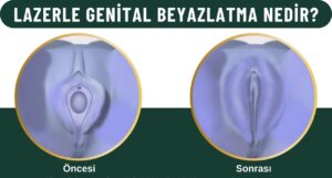 Lazerle genital estetik Kadınlar kulübü doktor takvimi doktorumsun en iyi lazerle rahim lazer ile lazerle genital klitoris vajina dış iç dudak labium labioplasti labiaplasty labioplasty vajinoplasti daraltma beyazlatma sıkılaştırma PRP ozon orgasm orgazm G noktası G spot G shot O noktası O spot O shot dolgusu aşısı gençleştirme rejuveneation rejuvenasyon sarkması sarkıklığı küçültme küçültülmesi dolgusu dolgunlaştırma estetik estetiği ameliyatı lazerle tedavisi şekiller çeşitleri izi fiyat fiyatı fiyatları ücret ücreti ücretleri yaptıranlar yorumlar yaptıranların yorumları kadınlar kulübü ekşi before after öncesi sonrası resim fotoğraf video izle randevu veren yapan bay erkek bayan kadın doktor doktorlar hastane hastaneler hastanesi klinik klinikler kliniği 2019 2020 2021 2022 2023 ucuz en uygun hesaplı fiyat fiyatları fiyatı fiyatlı ücret ücreti ücretleri maliyet maliyeti rakam rakamları neden ne kadar nedir nasıl yapılır İstanbul’da İstanbul Avrupa yakası Anadolu yakası Türkiye, Adana, Adıyaman, Afyonkarahisar, Ağrı, Aksaray, Amasya, Ankara, Antalya, Ardahan, Artvin, Aydın, Balıkesir, Bartın, Batman, Bayburt, Bilecik, Bingöl, Bitlis, Bolu, Burdur, Bursa, Çanakkale, Çankırı, Çorum, Denizli, Diyarbakır, Düzce, Edirne, Elazığ, Erzincan, Erzurum, Eskişehir, Gaziantep, Giresun, Gümüşhane, Hakkâri, Hatay, Iğdır, Isparta, İstanbul, İzmir, Kahramanmaraş, Karabük, Karaman, Kars, Kastamonu, Kayseri, Kilis, Kırıkkale, Kırklareli, Kırşehir, Kocaeli, Konya, Kütahya, Malatya, Manisa, Mardin, Mersin, Muğla, Muş, Nevşehir, Niğde, Ordu, Osmaniye, Rize, Sakarya, Samsun, Şanlıurfa, Siirt, Sinop, Sivas, Şırnak, Tekirdağ, Tokat, Trabzon, Tunceli, Uşak, Van, Yalova, Yozgat, Zonguldak, Karaman, Fethiye, Bodrum, Adalar, Arnavutköy, Ataşehir, Avcılar, Bağcılar, Bahçelievler, Bakırköy, Başakşehir, Bayrampaşa, Beşiktaş, Beykoz, Beylikdüzü, Beyoğlu, Büyükçekmece, Çatalca, Çekmeköy, Esenler, Esenyurt, Eyüp, Fatih, Gaziosmanpaşa, Güngören, Kadıköy, Kağıthane, Kartal, Küçükçekmece, Maltepe, Pendik, Sancaktepe, Sarıyer, Silivri, Sultanbeyli, Sultangazi, Şile, Şişli, Tuzla, Ümraniye, Üsküdar, Zeytinburnu, Şişli, Nişantaşı, Mecidiyeköy, Acıbadem, Gebze, Çorlu, Tarsus, Viranşehir Kadınlar kulübü doktor takvimi doktorumsun en iyi lazerle rahim lazer ile lazerle genital vajina klitoris dış iç dudak labium labioplasti labiaplasty labioplasty vajinoplasti daraltma beyazlatma sıkılaştırma PRP ozon orgasm orgazm G noktası G spot G shot O noktası O spot O shot dolgusu aşısı gençleştirme rejuveneation rejuvenasyon sarkması sarkıklığı küçültme küçültülmesi dolgusu dolgunlaştırma estetik estetiği ameliyatı lazerle tedavisi şekiller çeşitleri izi fiyat fiyatı fiyatları ücret ücreti ücretleri yaptıranlar yorumlar yaptıranların yorumları kadınlar kulübü ekşi before after öncesi sonrası resim fotoğraf video izle randevu veren yapan bay erkek bayan kadın doktor doktorlar hastane hastaneler hastanesi klinik klinikler kliniği 2019 2020 2021 2022 2023 ucuz en uygun hesaplı fiyat fiyatları fiyatı fiyatlı ücret ücreti ücretleri maliyet maliyeti rakam rakamları neden ne kadar nedir nasıl yapılır Türkiye, Adana, Adıyaman, Afyonkarahisar, Ağrı, Aksaray, Amasya, Ankara, Antalya, Ardahan, Artvin, Aydın, Balıkesir, Bartın, Batman, Bayburt, Bilecik, Bingöl, Bitlis, Bolu, Burdur, Bursa, Çanakkale, Çankırı, Çorum, Denizli, Diyarbakır, Düzce, Edirne, Elazığ, Erzincan, Erzurum, Eskişehir, Gaziantep, Giresun, Gümüşhane, Hakkâri, Hatay, Iğdır, Isparta, İstanbul, İzmir, Kahramanmaraş, Karabük, Karaman, Kars, Kastamonu, Kayseri, Kilis, Kırıkkale, Kırklareli, Kırşehir, Kocaeli, Konya, Kütahya, Malatya, Manisa, Mardin, Mersin, Muğla, Muş, Nevşehir, Niğde, Ordu, Osmaniye, Rize, Sakarya, Samsun, Şanlıurfa, Siirt, Sinop, Sivas, Şırnak, Tekirdağ, Tokat, Trabzon, Tunceli, Uşak, Van, Yalova, Yozgat, Zonguldak, Karaman, Fethiye, Bodrum, Adalar, Arnavutköy, Ataşehir, Avcılar, Bağcılar, Bahçelievler, Bakırköy, Başakşehir, Bayrampaşa, Beşiktaş, Beykoz, Beylikdüzü, Beyoğlu, Büyükçekmece, Çatalca, Çekmeköy, Esenler, Esenyurt, Eyüp, Fatih, Gaziosmanpaşa, Güngören, Kadıköy, Kağıthane, Kartal, Küçükçekmece, Maltepe, Pendik, Sancaktepe, Sarıyer, Silivri, Sultanbeyli, Sultangazi, Şile, Şişli, Tuzla, Ümraniye, Üsküdar, Zeytinburnu, Şişli, Nişantaşı, Mecidiyeköy, Acıbadem, Gebze, Çorlu, Tarsus, Viranşehir, İstanbul Avrupa yakası Anadolu yakası Kadınlar kulübü doktor takvimi doktorumsun en iyi lazerle rahim lazer ile lazerle genital vajina klitoris dış iç dudak labium labioplasti labiaplasty labioplasty vajinoplasti daraltma beyazlatma sıkılaştırma PRP ozon orgasm orgazm G noktası G spot G shot O noktası O spot O shot dolgusu aşısı gençleştirme rejuveneation rejuvenasyon sarkması sarkıklığı küçültme küçültülmesi dolgusu dolgunlaştırma estetik estetiği ameliyatı lazerle tedavisi şekiller çeşitleri izi fiyat fiyatı fiyatları ücret ücreti ücretleri yaptıranlar yorumlar yaptıranların yorumları kadınlar kulübü ekşi before after öncesi sonrası resim fotoğraf video izle randevu veren yapan bay erkek bayan kadın doktor doktorlar hastane hastaneler hastanesi klinik klinikler kliniği 2019 2020 2021 2022 2023 ucuz en uygun hesaplı fiyat fiyatları fiyatı fiyatlı ücret ücreti ücretleri maliyet maliyeti rakam rakamları neden ne kadar nedir nasıl yapılır.
