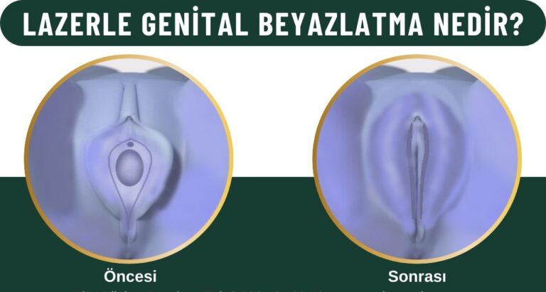 Lazerle genital estetik Kadınlar kulübü doktor takvimi doktorumsun en iyi lazerle rahim lazer ile lazerle genital klitoris vajina dış iç dudak labium labioplasti labiaplasty labioplasty vajinoplasti daraltma beyazlatma sıkılaştırma PRP ozon orgasm orgazm G noktası G spot G shot O noktası O spot O shot dolgusu aşısı gençleştirme rejuveneation rejuvenasyon sarkması sarkıklığı küçültme küçültülmesi dolgusu dolgunlaştırma estetik estetiği ameliyatı lazerle tedavisi şekiller çeşitleri izi fiyat fiyatı fiyatları ücret ücreti ücretleri yaptıranlar yorumlar yaptıranların yorumları kadınlar kulübü ekşi before after öncesi sonrası resim fotoğraf video izle randevu veren yapan bay erkek bayan kadın doktor doktorlar hastane hastaneler hastanesi klinik klinikler kliniği 2019 2020 2021 2022 2023 ucuz en uygun hesaplı fiyat fiyatları fiyatı fiyatlı ücret ücreti ücretleri maliyet maliyeti rakam rakamları neden ne kadar nedir nasıl yapılır İstanbul’da İstanbul Avrupa yakası Anadolu yakası Türkiye, Adana, Adıyaman, Afyonkarahisar, Ağrı, Aksaray, Amasya, Ankara, Antalya, Ardahan, Artvin, Aydın, Balıkesir, Bartın, Batman, Bayburt, Bilecik, Bingöl, Bitlis, Bolu, Burdur, Bursa, Çanakkale, Çankırı, Çorum, Denizli, Diyarbakır, Düzce, Edirne, Elazığ, Erzincan, Erzurum, Eskişehir, Gaziantep, Giresun, Gümüşhane, Hakkâri, Hatay, Iğdır, Isparta, İstanbul, İzmir, Kahramanmaraş, Karabük, Karaman, Kars, Kastamonu, Kayseri, Kilis, Kırıkkale, Kırklareli, Kırşehir, Kocaeli, Konya, Kütahya, Malatya, Manisa, Mardin, Mersin, Muğla, Muş, Nevşehir, Niğde, Ordu, Osmaniye, Rize, Sakarya, Samsun, Şanlıurfa, Siirt, Sinop, Sivas, Şırnak, Tekirdağ, Tokat, Trabzon, Tunceli, Uşak, Van, Yalova, Yozgat, Zonguldak, Karaman, Fethiye, Bodrum, Adalar, Arnavutköy, Ataşehir, Avcılar, Bağcılar, Bahçelievler, Bakırköy, Başakşehir, Bayrampaşa, Beşiktaş, Beykoz, Beylikdüzü, Beyoğlu, Büyükçekmece, Çatalca, Çekmeköy, Esenler, Esenyurt, Eyüp, Fatih, Gaziosmanpaşa, Güngören, Kadıköy, Kağıthane, Kartal, Küçükçekmece, Maltepe, Pendik, Sancaktepe, Sarıyer, Silivri, Sultanbeyli, Sultangazi, Şile, Şişli, Tuzla, Ümraniye, Üsküdar, Zeytinburnu, Şişli, Nişantaşı, Mecidiyeköy, Acıbadem, Gebze, Çorlu, Tarsus, Viranşehir Kadınlar kulübü doktor takvimi doktorumsun en iyi lazerle rahim lazer ile lazerle genital vajina klitoris dış iç dudak labium labioplasti labiaplasty labioplasty vajinoplasti daraltma beyazlatma sıkılaştırma PRP ozon orgasm orgazm G noktası G spot G shot O noktası O spot O shot dolgusu aşısı gençleştirme rejuveneation rejuvenasyon sarkması sarkıklığı küçültme küçültülmesi dolgusu dolgunlaştırma estetik estetiği ameliyatı lazerle tedavisi şekiller çeşitleri izi fiyat fiyatı fiyatları ücret ücreti ücretleri yaptıranlar yorumlar yaptıranların yorumları kadınlar kulübü ekşi before after öncesi sonrası resim fotoğraf video izle randevu veren yapan bay erkek bayan kadın doktor doktorlar hastane hastaneler hastanesi klinik klinikler kliniği 2019 2020 2021 2022 2023 ucuz en uygun hesaplı fiyat fiyatları fiyatı fiyatlı ücret ücreti ücretleri maliyet maliyeti rakam rakamları neden ne kadar nedir nasıl yapılır Türkiye, Adana, Adıyaman, Afyonkarahisar, Ağrı, Aksaray, Amasya, Ankara, Antalya, Ardahan, Artvin, Aydın, Balıkesir, Bartın, Batman, Bayburt, Bilecik, Bingöl, Bitlis, Bolu, Burdur, Bursa, Çanakkale, Çankırı, Çorum, Denizli, Diyarbakır, Düzce, Edirne, Elazığ, Erzincan, Erzurum, Eskişehir, Gaziantep, Giresun, Gümüşhane, Hakkâri, Hatay, Iğdır, Isparta, İstanbul, İzmir, Kahramanmaraş, Karabük, Karaman, Kars, Kastamonu, Kayseri, Kilis, Kırıkkale, Kırklareli, Kırşehir, Kocaeli, Konya, Kütahya, Malatya, Manisa, Mardin, Mersin, Muğla, Muş, Nevşehir, Niğde, Ordu, Osmaniye, Rize, Sakarya, Samsun, Şanlıurfa, Siirt, Sinop, Sivas, Şırnak, Tekirdağ, Tokat, Trabzon, Tunceli, Uşak, Van, Yalova, Yozgat, Zonguldak, Karaman, Fethiye, Bodrum, Adalar, Arnavutköy, Ataşehir, Avcılar, Bağcılar, Bahçelievler, Bakırköy, Başakşehir, Bayrampaşa, Beşiktaş, Beykoz, Beylikdüzü, Beyoğlu, Büyükçekmece, Çatalca, Çekmeköy, Esenler, Esenyurt, Eyüp, Fatih, Gaziosmanpaşa, Güngören, Kadıköy, Kağıthane, Kartal, Küçükçekmece, Maltepe, Pendik, Sancaktepe, Sarıyer, Silivri, Sultanbeyli, Sultangazi, Şile, Şişli, Tuzla, Ümraniye, Üsküdar, Zeytinburnu, Şişli, Nişantaşı, Mecidiyeköy, Acıbadem, Gebze, Çorlu, Tarsus, Viranşehir, İstanbul Avrupa yakası Anadolu yakası Kadınlar kulübü doktor takvimi doktorumsun en iyi lazerle rahim lazer ile lazerle genital vajina klitoris dış iç dudak labium labioplasti labiaplasty labioplasty vajinoplasti daraltma beyazlatma sıkılaştırma PRP ozon orgasm orgazm G noktası G spot G shot O noktası O spot O shot dolgusu aşısı gençleştirme rejuveneation rejuvenasyon sarkması sarkıklığı küçültme küçültülmesi dolgusu dolgunlaştırma estetik estetiği ameliyatı lazerle tedavisi şekiller çeşitleri izi fiyat fiyatı fiyatları ücret ücreti ücretleri yaptıranlar yorumlar yaptıranların yorumları kadınlar kulübü ekşi before after öncesi sonrası resim fotoğraf video izle randevu veren yapan bay erkek bayan kadın doktor doktorlar hastane hastaneler hastanesi klinik klinikler kliniği 2019 2020 2021 2022 2023 ucuz en uygun hesaplı fiyat fiyatları fiyatı fiyatlı ücret ücreti ücretleri maliyet maliyeti rakam rakamları neden ne kadar nedir nasıl yapılır.