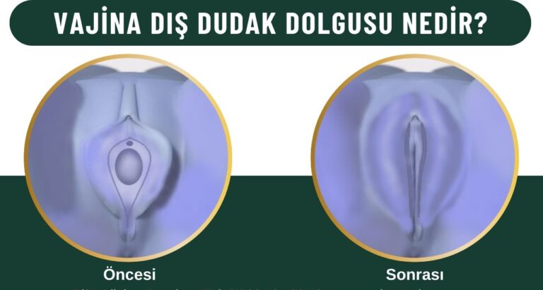 Vajina Dış Dudak Dolgusu - Vajina Dış Dudak Dolgusu, Vajina Dış Dudak, vajina dış dudak sarkması - Op. Dr. Aytaç İMREN Genital estetik Kadınlar kulübü doktor takvimi doktorumsun en iyi lazerle rahim genital klitoris vajina dış iç dudak labium labioplasti labiaplasty labioplasty vajinoplasti daraltma beyazlatma sıkılaştırma PRP ozon orgasm orgazm G noktası G spot G shot O noktası O spot O shot dolgusu aşısı gençleştirme rejuveneation sarkması sarkıklığı küçültme küçültülmesi dolgusu dolgunlaştırma estetik estetiği ameliyatı lazerle tedavisi şekiller çeşitleri izi fiyat fiyatı fiyatları ücret ücreti ücretleri yaptıranlar yorumlar yaptıranların yorumları kadınlar kulübü ekşi before after öncesi sonrası resim fotoğraf video izle randevu veren yapan bay erkek bayan kadın doktor doktorlar hastane hastaneler hastanesi klinik klinikler kliniği 2019 2020 2021 2022 2023 ucuz en uygun hesaplı fiyat fiyatları fiyatı fiyatlı ücret ücreti ücretleri maliyet maliyeti rakam rakamları neden ne kadar nedir nasıl yapılır İstanbul’da İstanbul Avrupa yakası Anadolu yakası Türkiye, Adana, Adıyaman, Afyonkarahisar, Ağrı, Aksaray, Amasya, Ankara, Antalya, Ardahan, Artvin, Aydın, Balıkesir, Bartın, Batman, Bayburt, Bilecik, Bingöl, Bitlis, Bolu, Burdur, Bursa, Çanakkale, Çankırı, Çorum, Denizli, Diyarbakır, Düzce, Edirne, Elazığ, Erzincan, Erzurum, Eskişehir, Gaziantep, Giresun, Gümüşhane, Hakkâri, Hatay, Iğdır, Isparta, İstanbul, İzmir, Kahramanmaraş, Karabük, Karaman, Kars, Kastamonu, Kayseri, Kilis, Kırıkkale, Kırklareli, Kırşehir, Kocaeli, Konya, Kütahya, Malatya, Manisa, Mardin, Mersin, Muğla, Muş, Nevşehir, Niğde, Ordu, Osmaniye, Rize, Sakarya, Samsun, Şanlıurfa, Siirt, Sinop, Sivas, Şırnak, Tekirdağ, Tokat, Trabzon, Tunceli, Uşak, Van, Yalova, Yozgat, Zonguldak, Karaman, Fethiye, Bodrum, Adalar, Arnavutköy, Ataşehir, Avcılar, Bağcılar, Bahçelievler, Bakırköy, Başakşehir, Bayrampaşa, Beşiktaş, Beykoz, Beylikdüzü, Beyoğlu, Büyükçekmece, Çatalca, Çekmeköy, Esenler, Esenyurt, Eyüp, Fatih, Gaziosmanpaşa, Güngören, Kadıköy, Kağıthane, Kartal, Küçükçekmece, Maltepe, Pendik, Sancaktepe, Sarıyer, Silivri, Sultanbeyli, Sultangazi, Şile, Şişli, Tuzla, Ümraniye, Üsküdar, Zeytinburnu, Şişli, Nişantaşı, Mecidiyeköy, Acıbadem, Gebze, Çorlu, Tarsus, Viranşehir Kadınlar kulübü doktor takvimi doktorumsun en iyi lazerle rahim genital vajina klitoris dış iç dudak labium labioplasti labiaplasty labioplasty vajinoplasti daraltma beyazlatma sıkılaştırma PRP ozon orgasm orgazm G noktası G spot G shot O noktası O spot O shot dolgusu aşısı gençleştirme rejuveneation sarkması sarkıklığı küçültme küçültülmesi dolgusu dolgunlaştırma estetik estetiği ameliyatı lazerle tedavisi şekiller çeşitleri izi fiyat fiyatı fiyatları ücret ücreti ücretleri yaptıranlar yorumlar yaptıranların yorumları kadınlar kulübü ekşi before after öncesi sonrası resim fotoğraf video izle randevu veren yapan bay erkek bayan kadın doktor doktorlar hastane hastaneler hastanesi klinik klinikler kliniği 2019 2020 2021 2022 2023 ucuz en uygun hesaplı fiyat fiyatları fiyatı fiyatlı ücret ücreti ücretleri maliyet maliyeti rakam rakamları neden ne kadar nedir nasıl yapılır Türkiye, Adana, Adıyaman, Afyonkarahisar, Ağrı, Aksaray, Amasya, Ankara, Antalya, Ardahan, Artvin, Aydın, Balıkesir, Bartın, Batman, Bayburt, Bilecik, Bingöl, Bitlis, Bolu, Burdur, Bursa, Çanakkale, Çankırı, Çorum, Denizli, Diyarbakır, Düzce, Edirne, Elazığ, Erzincan, Erzurum, Eskişehir, Gaziantep, Giresun, Gümüşhane, Hakkâri, Hatay, Iğdır, Isparta, İstanbul, İzmir, Kahramanmaraş, Karabük, Karaman, Kars, Kastamonu, Kayseri, Kilis, Kırıkkale, Kırklareli, Kırşehir, Kocaeli, Konya, Kütahya, Malatya, Manisa, Mardin, Mersin, Muğla, Muş, Nevşehir, Niğde, Ordu, Osmaniye, Rize, Sakarya, Samsun, Şanlıurfa, Siirt, Sinop, Sivas, Şırnak, Tekirdağ, Tokat, Trabzon, Tunceli, Uşak, Van, Yalova, Yozgat, Zonguldak, Karaman, Fethiye, Bodrum, Adalar, Arnavutköy, Ataşehir, Avcılar, Bağcılar, Bahçelievler, Bakırköy, Başakşehir, Bayrampaşa, Beşiktaş, Beykoz, Beylikdüzü, Beyoğlu, Büyükçekmece, Çatalca, Çekmeköy, Esenler, Esenyurt, Eyüp, Fatih, Gaziosmanpaşa, Güngören, Kadıköy, Kağıthane, Kartal, Küçükçekmece, Maltepe, Pendik, Sancaktepe, Sarıyer, Silivri, Sultanbeyli, Sultangazi, Şile, Şişli, Tuzla, Ümraniye, Üsküdar, Zeytinburnu, Şişli, Nişantaşı, Mecidiyeköy, Acıbadem, Gebze, Çorlu, Tarsus, Viranşehir, İstanbul Avrupa yakası Anadolu yakası Kadınlar kulübü doktor takvimi doktorumsun en iyi lazerle rahim genital vajina klitoris dış iç dudak labium labioplasti labiaplasty labioplasty vajinoplasti daraltma beyazlatma sıkılaştırma PRP ozon orgasm orgazm G noktası G spot G shot O noktası O spot O shot dolgusu aşısı gençleştirme rejuveneation sarkması sarkıklığı küçültme küçültülmesi dolgusu dolgunlaştırma estetik estetiği ameliyatı lazerle tedavisi şekiller çeşitleri izi fiyat fiyatı fiyatları ücret ücreti ücretleri yaptıranlar yorumlar yaptıranların yorumları kadınlar kulübü ekşi before after öncesi sonrası resim fotoğraf video izle randevu veren yapan bay erkek bayan kadın doktor doktorlar hastane hastaneler hastanesi klinik klinikler kliniği 2019 2020 2021 2022 2023 ucuz en uygun hesaplı fiyat fiyatları fiyatı fiyatlı ücret ücreti ücretleri maliyet maliyeti rakam rakamları neden ne kadar nedir nasıl yapılır.
