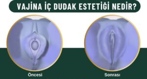 İç dudak estetiği labioplasti Kadınlar kulübü doktor takvimi doktorumsun en iyi lazerle rahim genital vajina dış iç dudak labium labioplasti labiaplasty labioplasty sarkması sarkıklığı küçültme küçültülmesi dolgusu dolgunlaştırma estetik estetiği ameliyatı lazerle şekiller çeşitleri kanama ağrı süre kanaması ağrısı süresi izi ucuz en uygun hesaplı fiyatlı fiyat fiyatı fiyatları ücret ücreti ücretleri yaptıranlar yorumlar yaptıranların yorumları kadınlar kulübü 2019 2020 2021 2022 2023 ekşi before after öncesi sonrası resim fotoğraf video izle randevu veren yapan hastane hastaneler bayan kadın doktor doktorlar klinik klinikler kliniği neden ne kadar nedir nasıl yapılır Türkiye İstanbul’da İstanbul Avrupa yakası Anadolu yakası Türkiye, Adana, Adıyaman, Afyonkarahisar, Ağrı, Aksaray, Amasya, Ankara, Antalya, Ardahan, Artvin, Aydın, Balıkesir, Bartın, Batman, Bayburt, Bilecik, Bingöl, Bitlis, Bolu, Burdur, Bursa, Çanakkale, Çankırı, Çorum, Denizli, Diyarbakır, Düzce, Edirne, Elazığ, Erzincan, Erzurum, Eskişehir, Gaziantep, Giresun, Gümüşhane, Hakkâri, Hatay, Iğdır, Isparta, İstanbul, İzmir, Kahramanmaraş, Karabük, Karaman, Kars, Kastamonu, Kayseri, Kilis, Kırıkkale, Kırklareli, Kırşehir, Kocaeli, Konya, Kütahya, Malatya, Manisa, Mardin, Mersin, Muğla, Muş, Nevşehir, Niğde, Ordu, Osmaniye, Rize, Sakarya, Samsun, Şanlıurfa, Siirt, Sinop, Sivas, Şırnak, Tekirdağ, Tokat, Trabzon, Tunceli, Uşak, Van, Yalova, Yozgat, Zonguldak, Karaman, Fethiye, Bodrum, Adalar, Arnavutköy, Ataşehir, Avcılar, Bağcılar, Bahçelievler, Bakırköy, Başakşehir, Bayrampaşa, Beşiktaş, Beykoz, Beylikdüzü, Beyoğlu, Büyükçekmece, Çatalca, Çekmeköy, Esenler, Esenyurt, Eyüp, Fatih, Gaziosmanpaşa, Güngören, Kadıköy, Kağıthane, Kartal, Küçükçekmece, Maltepe, Pendik, Sancaktepe, Sarıyer, Silivri, Sultanbeyli, Sultangazi, Şile, Şişli, Tuzla, Ümraniye, Üsküdar, Zeytinburnu, Şişli, Nişantaşı, Mecidiyeköy, Acıbadem, Gebze, Çorlu, Tarsus, Viranşehir Kadınlar kulübü doktor takvimi doktorumsun en iyi lazerle rahim genital vajina dış iç dudak labium labioplasti labiaplasty labioplasty sarkması sarkıklığı küçültme küçültülmesi dolgusu dolgunlaştırma estetik estetiği ameliyatı lazerle şekiller çeşitleri kanama ağrı süre kanaması ağrısı süresi izi ucuz en uygun hesaplı fiyatlı fiyat fiyatı fiyatları ücret ücreti ücretleri yaptıranlar yorumlar yaptıranların yorumları kadınlar kulübü 2019 2020 2021 2022 2023 ekşi before after öncesi sonrası resim fotoğraf video izle randevu veren yapan hastane hastaneler bayan kadın doktor doktorlar klinik klinikler kliniği neden ne kadar nedir nasıl yapılır Türkiye İstanbul’da, Adana, Adıyaman, Afyonkarahisar, Ağrı, Aksaray, Amasya, Ankara, Antalya, Ardahan, Artvin, Aydın, Balıkesir, Bartın, Batman, Bayburt, Bilecik, Bingöl, Bitlis, Bolu, Burdur, Bursa, Çanakkale, Çankırı, Çorum, Denizli, Diyarbakır, Düzce, Edirne, Elazığ, Erzincan, Erzurum, Eskişehir, Gaziantep, Giresun, Gümüşhane, Hakkâri, Hatay, Iğdır, Isparta, İstanbul, İzmir, Kahramanmaraş, Karabük, Karaman, Kars, Kastamonu, Kayseri, Kilis, Kırıkkale, Kırklareli, Kırşehir, Kocaeli, Konya, Kütahya, Malatya, Manisa, Mardin, Mersin, Muğla, Muş, Nevşehir, Niğde, Ordu, Osmaniye, Rize, Sakarya, Samsun, Şanlıurfa, Siirt, Sinop, Sivas, Şırnak, Tekirdağ, Tokat, Trabzon, Tunceli, Uşak, Van, Yalova, Yozgat, Zonguldak, Karaman, Fethiye, Bodrum, Adalar, Arnavutköy, Ataşehir, Avcılar, Bağcılar, Bahçelievler, Bakırköy, Başakşehir, Bayrampaşa, Beşiktaş, Beykoz, Beylikdüzü, Beyoğlu, Büyükçekmece, Çatalca, Çekmeköy, Esenler, Esenyurt, Eyüp, Fatih, Gaziosmanpaşa, Güngören, Kadıköy, Kağıthane, Kartal, Küçükçekmece, Maltepe, Pendik, Sancaktepe, Sarıyer, Silivri, Sultanbeyli, Sultangazi, Şile, Şişli, Tuzla, Ümraniye, Üsküdar, Zeytinburnu, Şişli, Nişantaşı, Mecidiyeköy, Acıbadem, Gebze, Çorlu, Tarsus, Viranşehir, İstanbul Avrupa yakası Anadolu yakası Kadınlar kulübü doktor takvimi doktorumsun en iyi lazerle rahim genital vajina dış iç dudak labium labioplasti labiaplasty labioplasty sarkması sarkıklığı küçültme küçültülmesi dolgusu dolgunlaştırma estetik estetiği ameliyatı lazerle şekiller çeşitleri kanama ağrı süre kanaması ağrısı süresi izi ucuz en uygun hesaplı fiyatlı fiyat fiyatı fiyatları ücret ücreti ücretleri yaptıranlar yorumlar yaptıranların yorumları kadınlar kulübü 2019 2020 2021 2022 2023 ekşi before after öncesi sonrası resim fotoğraf video izle randevu veren yapan hastane hastaneler bayan kadın doktor doktorlar klinik klinikler kliniği neden ne kadar nedir nasıl yapılır.