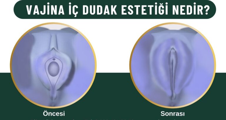 İç dudak estetiği labioplasti Kadınlar kulübü doktor takvimi doktorumsun en iyi lazerle rahim genital vajina dış iç dudak labium labioplasti labiaplasty labioplasty sarkması sarkıklığı küçültme küçültülmesi dolgusu dolgunlaştırma estetik estetiği ameliyatı lazerle şekiller çeşitleri kanama ağrı süre kanaması ağrısı süresi izi ucuz en uygun hesaplı fiyatlı fiyat fiyatı fiyatları ücret ücreti ücretleri yaptıranlar yorumlar yaptıranların yorumları kadınlar kulübü 2019 2020 2021 2022 2023 ekşi before after öncesi sonrası resim fotoğraf video izle randevu veren yapan hastane hastaneler bayan kadın doktor doktorlar klinik klinikler kliniği neden ne kadar nedir nasıl yapılır Türkiye İstanbul’da İstanbul Avrupa yakası Anadolu yakası Türkiye, Adana, Adıyaman, Afyonkarahisar, Ağrı, Aksaray, Amasya, Ankara, Antalya, Ardahan, Artvin, Aydın, Balıkesir, Bartın, Batman, Bayburt, Bilecik, Bingöl, Bitlis, Bolu, Burdur, Bursa, Çanakkale, Çankırı, Çorum, Denizli, Diyarbakır, Düzce, Edirne, Elazığ, Erzincan, Erzurum, Eskişehir, Gaziantep, Giresun, Gümüşhane, Hakkâri, Hatay, Iğdır, Isparta, İstanbul, İzmir, Kahramanmaraş, Karabük, Karaman, Kars, Kastamonu, Kayseri, Kilis, Kırıkkale, Kırklareli, Kırşehir, Kocaeli, Konya, Kütahya, Malatya, Manisa, Mardin, Mersin, Muğla, Muş, Nevşehir, Niğde, Ordu, Osmaniye, Rize, Sakarya, Samsun, Şanlıurfa, Siirt, Sinop, Sivas, Şırnak, Tekirdağ, Tokat, Trabzon, Tunceli, Uşak, Van, Yalova, Yozgat, Zonguldak, Karaman, Fethiye, Bodrum, Adalar, Arnavutköy, Ataşehir, Avcılar, Bağcılar, Bahçelievler, Bakırköy, Başakşehir, Bayrampaşa, Beşiktaş, Beykoz, Beylikdüzü, Beyoğlu, Büyükçekmece, Çatalca, Çekmeköy, Esenler, Esenyurt, Eyüp, Fatih, Gaziosmanpaşa, Güngören, Kadıköy, Kağıthane, Kartal, Küçükçekmece, Maltepe, Pendik, Sancaktepe, Sarıyer, Silivri, Sultanbeyli, Sultangazi, Şile, Şişli, Tuzla, Ümraniye, Üsküdar, Zeytinburnu, Şişli, Nişantaşı, Mecidiyeköy, Acıbadem, Gebze, Çorlu, Tarsus, Viranşehir Kadınlar kulübü doktor takvimi doktorumsun en iyi lazerle rahim genital vajina dış iç dudak labium labioplasti labiaplasty labioplasty sarkması sarkıklığı küçültme küçültülmesi dolgusu dolgunlaştırma estetik estetiği ameliyatı lazerle şekiller çeşitleri kanama ağrı süre kanaması ağrısı süresi izi ucuz en uygun hesaplı fiyatlı fiyat fiyatı fiyatları ücret ücreti ücretleri yaptıranlar yorumlar yaptıranların yorumları kadınlar kulübü 2019 2020 2021 2022 2023 ekşi before after öncesi sonrası resim fotoğraf video izle randevu veren yapan hastane hastaneler bayan kadın doktor doktorlar klinik klinikler kliniği neden ne kadar nedir nasıl yapılır Türkiye İstanbul’da, Adana, Adıyaman, Afyonkarahisar, Ağrı, Aksaray, Amasya, Ankara, Antalya, Ardahan, Artvin, Aydın, Balıkesir, Bartın, Batman, Bayburt, Bilecik, Bingöl, Bitlis, Bolu, Burdur, Bursa, Çanakkale, Çankırı, Çorum, Denizli, Diyarbakır, Düzce, Edirne, Elazığ, Erzincan, Erzurum, Eskişehir, Gaziantep, Giresun, Gümüşhane, Hakkâri, Hatay, Iğdır, Isparta, İstanbul, İzmir, Kahramanmaraş, Karabük, Karaman, Kars, Kastamonu, Kayseri, Kilis, Kırıkkale, Kırklareli, Kırşehir, Kocaeli, Konya, Kütahya, Malatya, Manisa, Mardin, Mersin, Muğla, Muş, Nevşehir, Niğde, Ordu, Osmaniye, Rize, Sakarya, Samsun, Şanlıurfa, Siirt, Sinop, Sivas, Şırnak, Tekirdağ, Tokat, Trabzon, Tunceli, Uşak, Van, Yalova, Yozgat, Zonguldak, Karaman, Fethiye, Bodrum, Adalar, Arnavutköy, Ataşehir, Avcılar, Bağcılar, Bahçelievler, Bakırköy, Başakşehir, Bayrampaşa, Beşiktaş, Beykoz, Beylikdüzü, Beyoğlu, Büyükçekmece, Çatalca, Çekmeköy, Esenler, Esenyurt, Eyüp, Fatih, Gaziosmanpaşa, Güngören, Kadıköy, Kağıthane, Kartal, Küçükçekmece, Maltepe, Pendik, Sancaktepe, Sarıyer, Silivri, Sultanbeyli, Sultangazi, Şile, Şişli, Tuzla, Ümraniye, Üsküdar, Zeytinburnu, Şişli, Nişantaşı, Mecidiyeköy, Acıbadem, Gebze, Çorlu, Tarsus, Viranşehir, İstanbul Avrupa yakası Anadolu yakası Kadınlar kulübü doktor takvimi doktorumsun en iyi lazerle rahim genital vajina dış iç dudak labium labioplasti labiaplasty labioplasty sarkması sarkıklığı küçültme küçültülmesi dolgusu dolgunlaştırma estetik estetiği ameliyatı lazerle şekiller çeşitleri kanama ağrı süre kanaması ağrısı süresi izi ucuz en uygun hesaplı fiyatlı fiyat fiyatı fiyatları ücret ücreti ücretleri yaptıranlar yorumlar yaptıranların yorumları kadınlar kulübü 2019 2020 2021 2022 2023 ekşi before after öncesi sonrası resim fotoğraf video izle randevu veren yapan hastane hastaneler bayan kadın doktor doktorlar klinik klinikler kliniği neden ne kadar nedir nasıl yapılır.