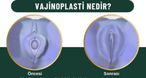 Vajina daraltma vajinoplasti Kadınlar kulübü doktor takvimi doktorumsun en iyi lazerle rahim genital vajina vajinoplasti vajinoplasty vajina daraltma genişleme genişlemesi daraltılması sıkılaştırma sarkması sarkıklığı küçültme küçültülmesi estetik estetiği ameliyatı lazerle şekiller çeşitleri kanama ağrı süre kanaması ağrısı süresi izi ucuz en uygun hesaplı fiyatlı fiyat fiyatı fiyatları ücret ücreti ücretleri yaptıranlar yorumlar yaptıranların yorumları kadınlar kulübü 2019 2020 2021 2022 2023 ekşi before after öncesi sonrası resim fotoğraf video izle randevu veren yapan hastane hastaneler bayan kadın doktor doktorlar klinik klinikler kliniği neden ne kadar nedir nasıl yapılır Türkiye İstanbul’da İstanbul Avrupa yakası Anadolu yakası Türkiye, Adana, Adıyaman, Afyonkarahisar, Ağrı, Aksaray, Amasya, Ankara, Antalya, Ardahan, Artvin, Aydın, Balıkesir, Bartın, Batman, Bayburt, Bilecik, Bingöl, Bitlis, Bolu, Burdur, Bursa, Çanakkale, Çankırı, Çorum, Denizli, Diyarbakır, Düzce, Edirne, Elazığ, Erzincan, Erzurum, Eskişehir, Gaziantep, Giresun, Gümüşhane, Hakkâri, Hatay, Iğdır, Isparta, İstanbul, İzmir, Kahramanmaraş, Karabük, Karaman, Kars, Kastamonu, Kayseri, Kilis, Kırıkkale, Kırklareli, Kırşehir, Kocaeli, Konya, Kütahya, Malatya, Manisa, Mardin, Mersin, Muğla, Muş, Nevşehir, Niğde, Ordu, Osmaniye, Rize, Sakarya, Samsun, Şanlıurfa, Siirt, Sinop, Sivas, Şırnak, Tekirdağ, Tokat, Trabzon, Tunceli, Uşak, Van, Yalova, Yozgat, Zonguldak, Karaman, Fethiye, Bodrum, Adalar, Arnavutköy, Ataşehir, Avcılar, Bağcılar, Bahçelievler, Bakırköy, Başakşehir, Bayrampaşa, Beşiktaş, Beykoz, Beylikdüzü, Beyoğlu, Büyükçekmece, Çatalca, Çekmeköy, Esenler, Esenyurt, Eyüp, Fatih, Gaziosmanpaşa, Güngören, Kadıköy, Kağıthane, Kartal, Küçükçekmece, Maltepe, Pendik, Sancaktepe, Sarıyer, Silivri, Sultanbeyli, Sultangazi, Şile, Şişli, Tuzla, Ümraniye, Üsküdar, Zeytinburnu, Şişli, Nişantaşı, Mecidiyeköy, Acıbadem, Gebze, Çorlu, Tarsus, Viranşehir Kadınlar kulübü doktor takvimi doktorumsun en iyi lazerle rahim genital vajina vajinoplasti vajinoplasty vajina daraltma genişleme genişlemesi daraltılması sıkılaştırma sarkması sarkıklığı küçültme küçültülmesi estetik estetiği ameliyatı lazerle şekiller çeşitleri kanama ağrı süre kanaması ağrısı süresi izi ucuz en uygun hesaplı fiyatlı fiyat fiyatı fiyatları ücret ücreti ücretleri yaptıranlar yorumlar yaptıranların yorumları kadınlar kulübü 2019 2020 2021 2022 2023 ekşi before after öncesi sonrası resim fotoğraf video izle randevu veren yapan hastane hastaneler bayan kadın doktor doktorlar klinik klinikler kliniği neden ne kadar nedir nasıl yapılır Türkiye İstanbul’da, Adana, Adıyaman, Afyonkarahisar, Ağrı, Aksaray, Amasya, Ankara, Antalya, Ardahan, Artvin, Aydın, Balıkesir, Bartın, Batman, Bayburt, Bilecik, Bingöl, Bitlis, Bolu, Burdur, Bursa, Çanakkale, Çankırı, Çorum, Denizli, Diyarbakır, Düzce, Edirne, Elazığ, Erzincan, Erzurum, Eskişehir, Gaziantep, Giresun, Gümüşhane, Hakkâri, Hatay, Iğdır, Isparta, İstanbul, İzmir, Kahramanmaraş, Karabük, Karaman, Kars, Kastamonu, Kayseri, Kilis, Kırıkkale, Kırklareli, Kırşehir, Kocaeli, Konya, Kütahya, Malatya, Manisa, Mardin, Mersin, Muğla, Muş, Nevşehir, Niğde, Ordu, Osmaniye, Rize, Sakarya, Samsun, Şanlıurfa, Siirt, Sinop, Sivas, Şırnak, Tekirdağ, Tokat, Trabzon, Tunceli, Uşak, Van, Yalova, Yozgat, Zonguldak, Karaman, Fethiye, Bodrum, Adalar, Arnavutköy, Ataşehir, Avcılar, Bağcılar, Bahçelievler, Bakırköy, Başakşehir, Bayrampaşa, Beşiktaş, Beykoz, Beylikdüzü, Beyoğlu, Büyükçekmece, Çatalca, Çekmeköy, Esenler, Esenyurt, Eyüp, Fatih, Gaziosmanpaşa, Güngören, Kadıköy, Kağıthane, Kartal, Küçükçekmece, Maltepe, Pendik, Sancaktepe, Sarıyer, Silivri, Sultanbeyli, Sultangazi, Şile, Şişli, Tuzla, Ümraniye, Üsküdar, Zeytinburnu, Şişli, Nişantaşı, Mecidiyeköy, Acıbadem, Gebze, Çorlu, Tarsus, Viranşehir, İstanbul Avrupa yakası Anadolu yakası Kadınlar kulübü doktor takvimi doktorumsun en iyi lazerle rahim genital vajina vajinoplasti vajinoplasty vajina daraltma genişleme genişlemesi daraltılması sıkılaştırma sarkması sarkıklığı küçültme küçültülmesi estetik estetiği ameliyatı lazerle şekiller çeşitleri kanama ağrı süre kanaması ağrısı süresi izi ucuz en uygun hesaplı fiyatlı fiyat fiyatı fiyatları ücret ücreti ücretleri yaptıranlar yorumlar yaptıranların yorumları kadınlar kulübü 2019 2020 2021 2022 2023 ekşi before after öncesi sonrası resim fotoğraf video izle randevu veren yapan hastane hastaneler bayan kadın doktor doktorlar klinik klinikler kliniği neden ne kadar nedir nasıl yapılır.